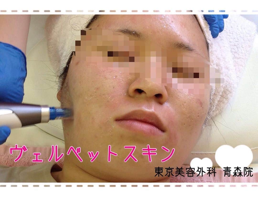 東京美容外科公式さんのインスタグラム写真 - (東京美容外科公式Instagram)「. 🌈ヴェルベットスキン🌈 . コラーゲンピールの効果をダーマペン4で真皮層にしっかり有効成分を浸透させ、毛穴の凹凸やニキビ跡の治療として人気の施術です😊💕 . 皮膚の表面に高密度に微小な穴をあけると、その傷を治そうと大量のコラーゲンが発生し、肌が本来持つ再生治癒力が働きます✨その肌の再生治癒力が毛穴の縮小やニキビ跡の改善、さらにはお肌のリフトアップにも繋がります🧸💜 . 表面麻酔をするのでほとんど痛みを感じず、施術を受けることができますよ🎵 . 🌻施術経過 施術後、赤みや内出血、皮向け、腫れが生じることがありますが、数日から1週間程度で改善していきます。また、肌のごわつきを感じる場合がありますが、お日にちの経過とともに徐々に改善していきます。 . 🐰施術サイクル 4〜6週間に1回程度をお勧めしております。 . お肌の状態やお悩みによって適応がございますので、しっかりと診察・カウンセリングを致しますので、ご安心くださいませ😌💉 .  . ==🎁お問い合わせはこちら🎁==== 詳しくはプロフィールのURLから公式サイトへ♪ ▼フリーダイヤル 0120-658-958 （コールセンター受付時間：9：00～21：00） ▼LINE予約 @ tkc110 ============== #東京美容外科 #東京美容外科青森院#美容整形 #きれい #整形 #美活 #綺麗になりたい #美肌 #美意識  #美容外科 #プチ整形 #ヴェルベットスキン#肌治療#コラーゲンピール#東美東北美肌#東美東北目元」8月16日 12時28分 - tokyobiyougeka_jimukyoku