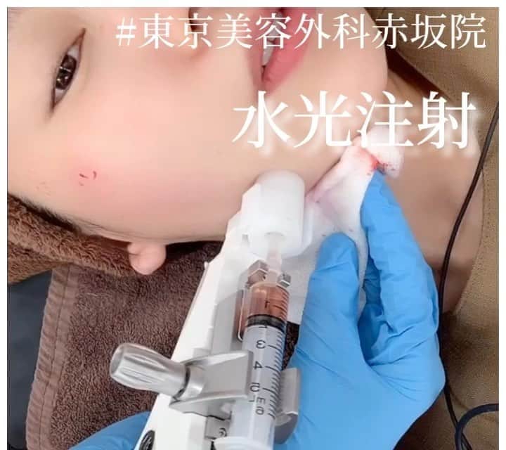 東京美容外科公式のインスタグラム：「こんにちは😃 東京美容外科赤坂院です✨✨ 夏に人気のボトックス水光注射の施術風景です💉 針で美容成分を注射するため、痛そうにも見えますが、施術前に麻酔クリームを使用するため、痛みもほとんどなく施術でき、 ハリや艶が蘇ります。またボトックスは顔の汗が出にくくなる効果も✨夏は特に汗でファンデーションがヨレてしまいますが、ボトックス水光の効果でメイクの持ちも良くなりますよ✨💄 . 赤みや点状出血の跡は翌日メイクをしたら、気にならない方がほとんどです🤗 ・ ⚠️針跡、赤み、内出血、針の痛み は出る場合がございます。   ==🎁お問い合わせはこちら🎁==== 詳しくはプロフィールのURLから公式サイトへ♪ ▼フリーダイヤル 0120-658-958 （コールセンター受付時間：9：00～21：00） ▼LINE予約 @ tkc110 ============== #東京美容外科 #東京美容外科赤坂院 #審美 #美容整形 #きれい #整形 #美活 #綺麗になりたい #美肌 #美意識  #美容外科 #プチ整形 #インビザライン#アンチエイジング #美容好き #歯科ドッグ #美容整形外科 #二重 #埋没法 #タルミ #小顔 #目の下のくま #涙袋#水光注射」