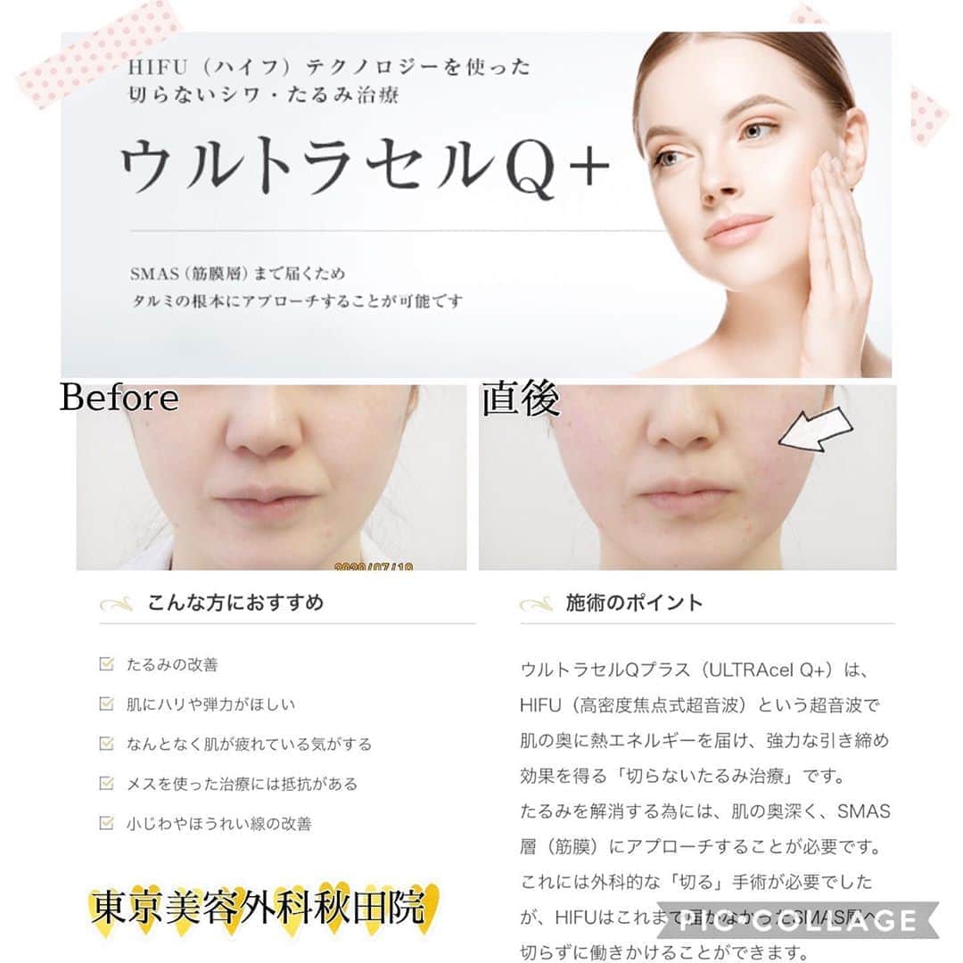 東京美容外科公式のインスタグラム：「大人気のウルトラセルQでしわ治療しませんか？😊❤️ . しわ、たるみが気になる、でも糸は怖い…😨そんな方におすすめです!!😲✨ .  SMAS（筋膜層）にアプローチ✨コラーゲン生成✨ 最小限の痛みで治療が可能、麻酔不要✨  . ご予約お待ちしております👩🏻‍⚕️❣️ . . ==🎁お問い合わせはこちら🎁==== 詳しくはプロフィールのURLから公式サイトへ♪ ▼フリーダイヤル 0120-658-958 （コールセンター受付時間：9：00～21：00） ▼LINE予約 @ tkc110 ============== #東京美容外科 #東京美容外科秋田院 #美容整形 #美肌#シワたるみ#綺麗になりたい#リジェスキンマスク #秋田#美容外科 #秋田院の202008#ハイフ#ウルトラセル#ウルトラセルQ」
