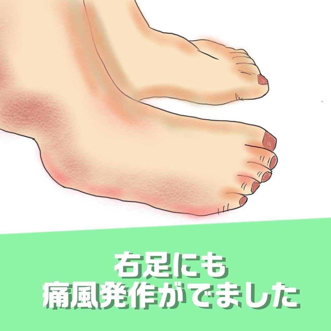 福島善成さんのインスタグラム写真 - (福島善成Instagram)「『続・痛風日記』 【御報告があります】 皆様の予想通りになりました 左足足首 右足かかと です。 ロキソニンを毎日飲ん 痛みは散らしてます。 ビール筋トレは休んでますが・・・ #続・痛風日記  #尿酸値高めの方へ」8月16日 17時24分 - fukushimayoshinari