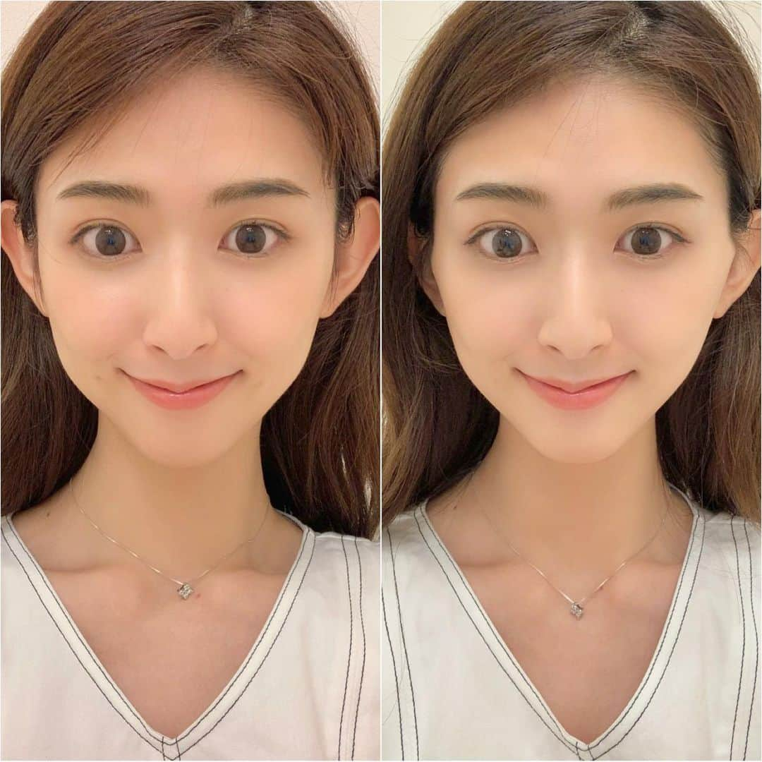 井上麻衣さんのインスタグラム写真 - (井上麻衣Instagram)「@a_clinic_ginza さんで、 Aスレッドを受けてきました♡ 担当していただいたのは @dr_kanayamasaki 先生✨  カウンセリングしてもらい 左側の方が肉が付きやすいから そのバランスも見て施術してもらいました♪ あとはエラの筋肉が張りやすいからボトックスもしたほうがいいよ。って アドバイスも☺️！ 今度やってもらおう〜💓💓  術後は腫れもなくてそのままお出かけしました❣️ 次の日撮影だったんだけど お化粧も入浴も当日からOKだから助かりました泣🙌  痛いのが大嫌いな私も大丈夫だったので やりたいけど怖い。不安。って思ってる人 安心してください♡  小顔になりたい人はAスレッドおすすめです☺️ . . . #aスレッド #aclinic #aclinic銀座 #aクリニック #美容 #小顔 #美肌 #リフトアップ #美容外科 #美容皮膚科 #美容クリニック#山崎香名」7月26日 12時56分 - mai_inoue