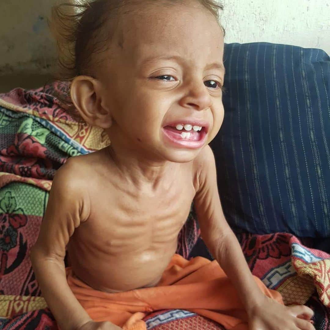 ティモシー・サイクスさんのインスタグラム写真 - (ティモシー・サイクスInstagram)「⚠️WARNING: GRAPHIC IMAGES⚠️ CLICK THE LINK IN @karmagawa BIO TO HELP CHILDREN IN YEMEN! Our Karmagawa Yemen fundraiser ends in 1 week and then we’ll donate the funds to several charities we’ve been talking to in order to deliver food, supplies & medicine as sadly millions of children are at risk of dying right now with one child dying every 10 minutes due to malnutrition so we MUST help them NOW! Even if you can’t donate, please share this post because Yemen is the largest humanitarian crisis in the world that nobody knows about, with more than 24 million people, 80% of the population in need of urgent help right now! Click the link in the @karmagawa bio to check our our charity fundraiser that’s now 85%+ of the way to achieving our goal so all donations, great and small, are so greatly appreciated! With coronavirus now breaking out across the country, Yemen is facing an even bigger emergency as food prices have doubled, making it out of reach for most people there so let’s raise money and spread awareness about this crisis, share this post with your followers & tell them to also share with their followers & tag celebrities, influencers and news media who need to see this too — let’s work together to help these innocent children or else millions will die in the next few weeks/months if we do nothing…SHARE & CLICK THE LINK IN THE @karmagawa BIO TO HELP YEMEN RIGHT NOW! #saveyemen #prayforyemen #yemen #karmagawa」7月27日 11時01分 - timothysykes
