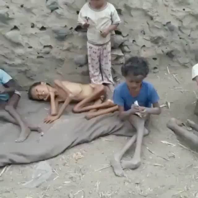 ティモシー・サイクスのインスタグラム：「⚠️WARNING: GRAPHIC IMAGES⚠️ CLICK THE LINK IN @karmagawa BIO TO HELP CHILDREN IN YEMEN! Our Karmagawa Yemen fundraiser ends in 1 week and then we’ll donate the funds to several charities we’ve been talking to in order to deliver food, supplies & medicine as sadly millions of children are at risk of dying right now with one child dying every 10 minutes due to malnutrition so we MUST help them NOW! Even if you can’t donate, please share this post because Yemen is the largest humanitarian crisis in the world that nobody knows about, with more than 24 million people, 80% of the population in need of urgent help right now! Click the link in the @karmagawa bio to check our our charity fundraiser that’s now 85%+ of the way to achieving our goal so all donations, great and small, are so greatly appreciated! With coronavirus now breaking out across the country, Yemen is facing an even bigger emergency as food prices have doubled, making it out of reach for most people there so let’s raise money and spread awareness about this crisis, share this post with your followers & tell them to also share with their followers & tag celebrities, influencers and news media who need to see this too — let’s work together to help these innocent children or else millions will die in the next few weeks/months if we do nothing…SHARE & CLICK THE LINK IN THE @karmagawa BIO TO HELP YEMEN RIGHT NOW! #saveyemen #prayforyemen #yemen #karmagawa」