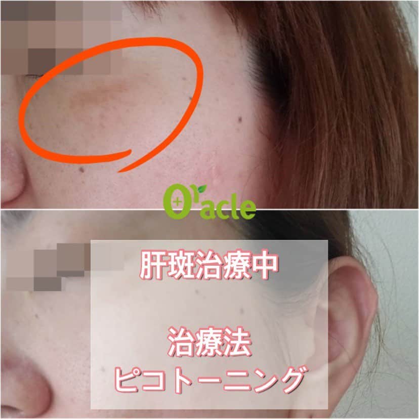 オラクル美容皮膚科東京新宿院さんのインスタグラム写真 - (オラクル美容皮膚科東京新宿院Instagram)「🔹肝斑治療中🔹﻿ 患者様から治療経過のお写真を送っていただきました🙏﻿ ﻿ ピコトーニングで肝斑治療中﻿ 5回施術数日後の写真です。﻿ ﻿ かなり薄くなってきていますね👍﻿ まずは6回の治療を予定しています。﻿ ﻿ ୨୧┈┈┈┈┈┈┈┈┈┈┈┈┈┈┈┈┈୨୧ ﻿ ﻿ 当院が採用しているエンライトンⅢのピコトーニングは肝斑治療にとても優れたレーザー機器です。﻿ ﻿ トーニングのため回数はある程度必要となりますが、お顔全体のくすみも改善されますので、肝斑以外の部分の効果も期待できます。﻿ ムラなくお顔全体を整えてくれます。﻿ ﻿ また、肝斑は内服治療とのセットがおすすめです。﻿ さらに肝斑を悪化させないためには日頃のUV対策もとても重要です。﻿ ﻿ ୨୧┈┈┈┈┈┈┈┈┈┈┈┈┈┈┈┈┈୨୧ ﻿ ﻿ ☑️マスク生活で肝斑ができた﻿ ☑️以前から肝斑で悩んでいる﻿ ☑️シミか肝斑か分からない﻿ などご相談ください。﻿ ﻿ ご予約の際に肝斑治療希望とお伝えください。﻿ ﻿ ୨୧┈┈┈┈┈┈┈┈┈┈┈┈┈┈┈┈┈୨୧﻿ 【料金】﻿ 初回1回 29.800円(税抜き)﻿ ※通常45,000円(税抜)﻿ ﻿ ୨୧┈┈┈┈┈┈┈┈┈┈┈┈┈┈┈┈┈୨୧ ﻿ ﻿ ⚠️リスクなど⚠️﻿ 直後赤みが出ることがあります。﻿ ﻿ 術後は乾燥しやすいので、保湿を十分行ってください。﻿ 紫外線の影響を受けやすくなっていますので、紫外線対策もしっかり行って下さい。﻿ ﻿  ୨୧┈┈┈┈┈┈┈┈┈┈┈┈┈┈┈┈┈୨୧ ﻿ ﻿ 🇯🇵オラクル美容皮膚科🇰🇷﻿ 📍東京新宿院﻿ 新宿3丁目19-4 MLJ新宿8階﻿ ﻿ 📍名古屋院﻿ 名古屋市中区錦3丁目24−4 サンシャイン栄5階﻿ ﻿ 【専門】﻿ ニキビ（跡）／毛穴／シミ／しわ／たるみ／痩身／アンチエイジング／美白美肌治療全般／ブライダル相談／メンズ美容﻿ ﻿ 🗝完全予約制﻿ 👠土日祝日も診療﻿ ﻿ 【予約方法】﻿ ☎0120-905-696﻿ ⏰9:00～21:00［年中無休］﻿ ﻿ LINE、メール24時間📧﻿ LINE🆔 @oracle.jp ﻿ 📩HPメールフォームよりお願いいたします﻿ ﻿ ▪️▫️▪️▫️▪️▫️▪️▫️▪️▫️﻿ ﻿ ﻿ #オラクル美容皮膚科 #オラクル #oracle #ピコトーニング #レーザー #レーザー治療 #レーザートーニング #シミ #シミケア #シミ取り #肝斑 #肝斑治療 #そばかす #ニキビ跡 #ニキビ跡ケア #ニキビ跡改善 #ニキビ #美白 #美白ケア #美白効果 #美肌 #美肌ケア #美肌レシピ #美肌になりたい #美肌作り #韓国美容 #韓国 #美容 #メンズ美容 #美容男子」7月28日 9時01分 - oraclejp