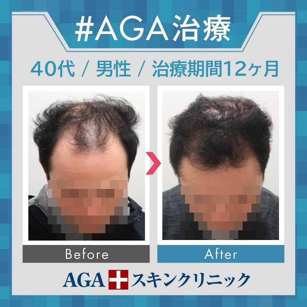【公式】AGAスキンクリニックさんのインスタグラム写真 - (【公式】AGAスキンクリニックInstagram)「⭐️AGAスキンクリニック　Before⇒After⭐️ . 〇40代男性のケース 〇治療期間12か月 〇内容 ⇒オリジナル発毛薬 ⇒Dr'sメソ治療（AGA メソセラピー） . 頭頂部・前頭部複合型のAGA進行でお悩みだった方です。 毛量がグッとアップしました😲 正面から見るとほとんど気にならなくなってきています☺☺ . AGAは早期治療が肝心です。 クリニックなど詳細は、@aga_clinic より公式HPをチェックしてみてください🥰 . . #AGAスキンクリニック #AGA #男性型脱毛症 #AGA治療 #薄毛 #薄毛治療 #抜毛 #発毛 #育毛 #治療 #薬 #ミノキシジル #AGAスキンクリニック症例 #男性ホルモン #フィナステリド #デュタステリド #初期脱毛 #美容男子 #髪質改善 #頭皮ケア」7月28日 18時01分 - aga_clinic
