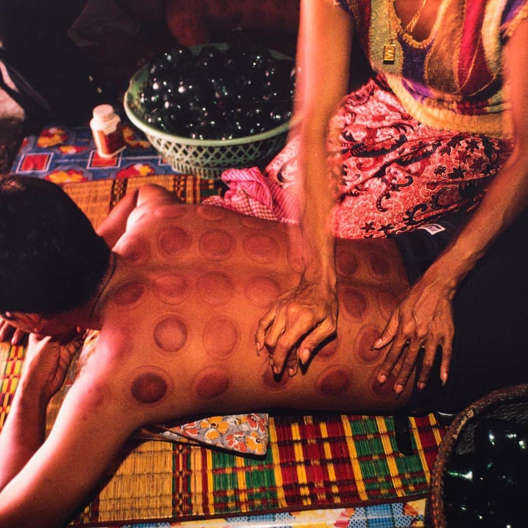 Michael Yamashitaさんのインスタグラム写真 - (Michael YamashitaInstagram)「Cupping in Cambodia: Cupping is an ancient form of Chinese medicine in which a therapist puts special glass cups on the skin for a few minutes to create suction. The therapist puts a flammable substance such as alcohol, herbs, or paper in a cup and sets it on fire. When the hot cup is placed on the skin, the air inside the cup cools and creates a vacuum that draws the skin and muscle upward into the cup. This causes the skin to rise and redden as your blood vessels expand. The cup is generally left in place for up to 3 minutes. Enthusiasts say the treatment cures whatever ails you, serving many purposes to help with pain, inflammation, blood flow, relaxation and well-being. Critics of alternative medicine have spoken out against traditional treatments like cupping as "pseudoscience nonsense" that relies on the placebo effect. #cuppingtherapy #cambodia #mekongmoments #mekonglife #phnompenh」7月30日 7時20分 - yamashitaphoto
