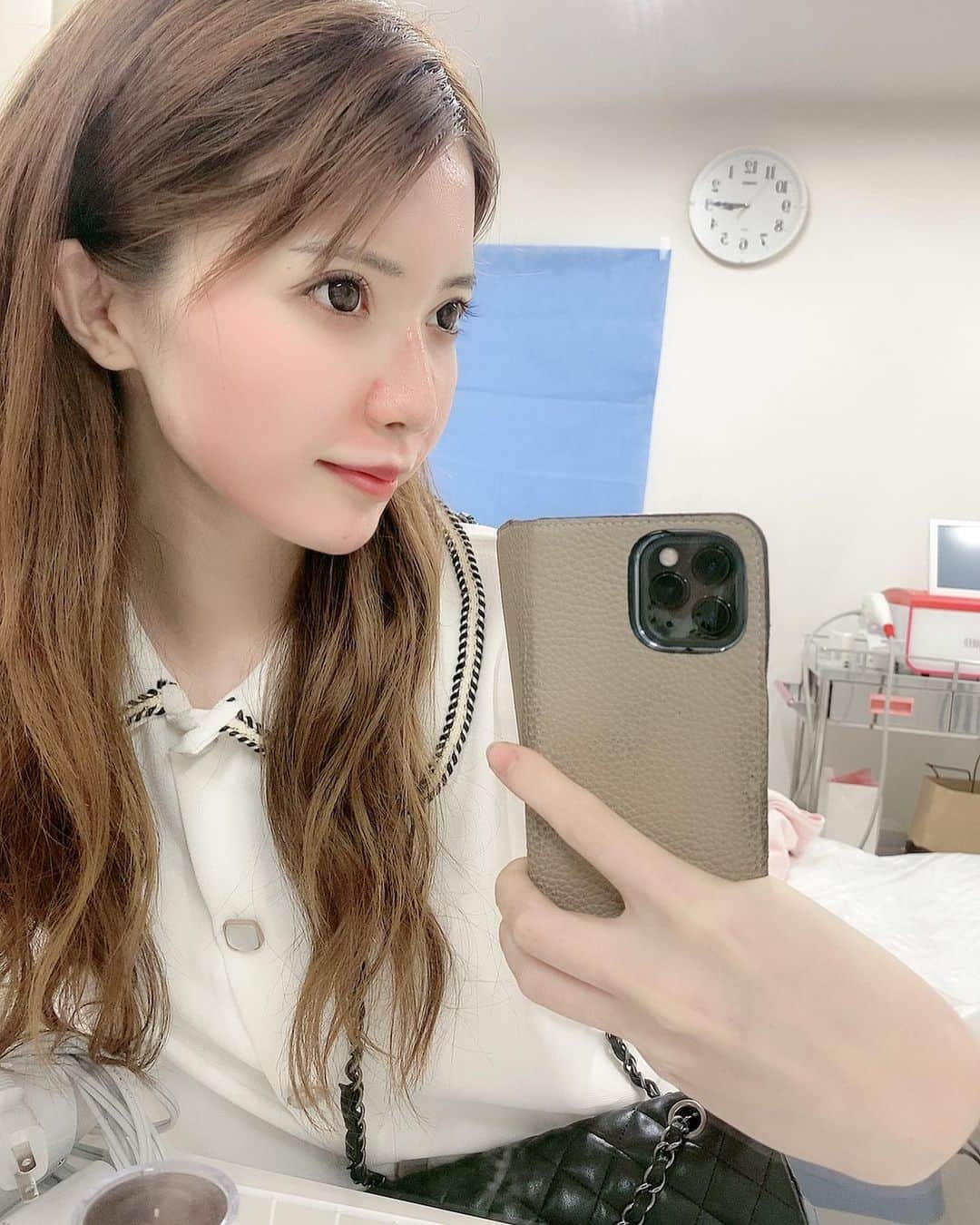 優月美羽さんのインスタグラム写真 - (優月美羽Instagram)「@venus_beauty_clinic に🚶‍♀💓💭 ダーマペン4 受けに久しぶりに💕 ダーマペン4 はもう3回目だよ🙊‼️ハマってる🤣めちゃいい🧏‍♀️🧡💜🧡  ダウンタイムは2、3日👀✌ 2、3日は赤み出てるけど 赤みもちゃんと引くよ♡ 洗顔は24時間後からOK🧖‍♀️🧡  数日後にはハリのあるお肌になるし毛穴も小さくなるし、頑固なニキビ跡にも🙆‍♀️✨ シワやタルミへの効果も期待できるみたいなのでアンチエイジングにも😊👍 術後のパックもすごく気持ちいよ😉🌿  #venusbeautyclinic #ヴィーナスビューティークリニック #新宿店 #新宿御苑 #ダーマペン4 #ダーマペン #アンチエイジング #美容クリニック #美容好きな人と繋がりたい #スキンケア #シワ改善 #美肌ケア #お肌ケア #ボトックス #ボトックス効果」7月30日 15時08分 - miu.yuzuki