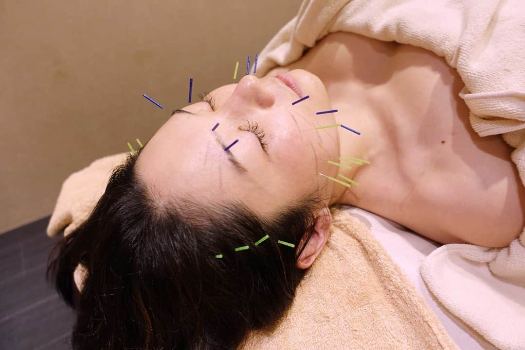 Ayanoのインスタグラム：「初めて美容鍼を体験してきました！普段から歯をくいしばるクセがあるので、今回はアゴを重点的にリフトアップトリートメントの施術をして頂きました💆‍♀️  施術直後から顎の力が程よく抜けて、奥歯のくいしばりが軽減されました。何より驚いたのは、施術を受けた次の日に肌の質感が確実に変わったことです。今まで自宅スキンケアではなかなか変化を感じられなかったのですが、鍼で皮膚の表皮の奥の真皮に近いところまで刺激してもらうと、こんなに違いを実感出来るのかと驚きました🥺✨ おうち時間が長くなりクーラーでお肌が乾燥気味の人にぜひ体験してもらいたいです。お店はウイルス対策も万全なので安心して通えます。  #小顔リフトアップ美鍼 #代々木上原 #ラコンシェル #美容鍼 #pr」