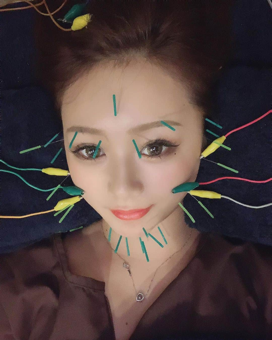 あゆぽよさんのインスタグラム写真 - (あゆぽよInstagram)「今日は顔と身体治療コース✌️  @dolce.acupuncture  ↑ここに行ってます！  浮腫みとれますように😌😌😌  #美容鍼 #ドルチェ #栄美容鍼 #名古屋美容鍼 #サボってました #ニキビ #できた #よく痛そうと言われるけど痛くない #ほんまやで #本当に #リラックス #する #身体治療 #美容 #今やりたいのは #ダーマペン #と #ハーブピーリング #と #ハイフ」8月4日 20時49分 - ayupoyo519