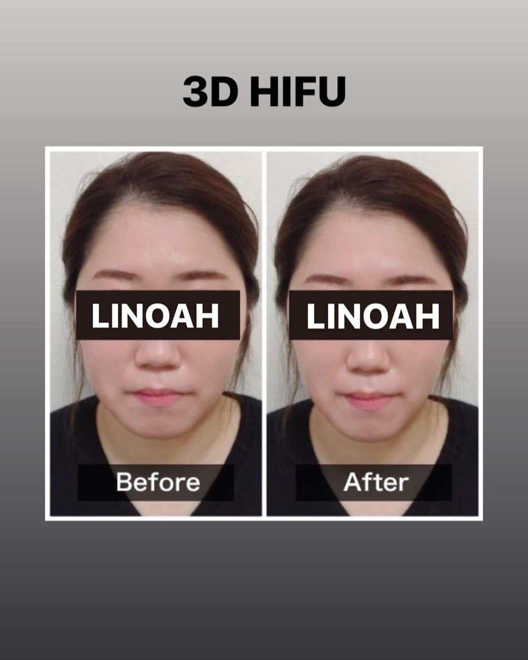 Beauty Salon LINOAHさんのインスタグラム写真 - (Beauty Salon LINOAHInstagram)「・﻿ 本日は【新メニュー】3D HIFUについてのご案内です。﻿ ﻿ 切らないリフトアップとも言われているHIFUは皆さんご存知でしょうか？﻿ ﻿ HIFU（ハイフ）とは高密度焦点照射式超音波治療（High Intensity Focused Ultrasound）の頭文字をとった略語です。﻿ ﻿ 高密度とはハイパワーのこと。﻿ ﻿ 焦点照射式とは、周囲にダメージを与えないということです。﻿ ﻿ つまり強力で周囲にダメージを与えない超音波で、切らないで腫れないお顔のフェイスアップをする施術ということです。﻿ ﻿ 皮膚の下だけに特殊超音波が作用し、切らない腫れないフェイスリフトを実現させます。﻿ ﻿ HIFU（ハイフ）には旧世代と新世代があります。﻿ 旧世代のHIFU（ハイフ）は線照射（２Ｄ）で照射に当てむらが起こります。﻿ ﻿ そのため効果が弱く、多少のリフトアップ効果しかありませんでした。﻿ ﻿ ※正確には線照射は１Ｄです。ですが深さを変えて照射することにより２Ｄ効果がでます。﻿ ﻿ ここでは分かりやすく２Ｄと表現致します。﻿ ﻿ 新世代HIFU（ハイフ）は面照射（３Ｄ）で、均一に照射でき、効果が強く、強力なリフトアップ効果と小顔効果を発揮します。﻿ ﻿ パワフルになった分、小顔効果が発揮できるわけです。﻿ ﻿ 3D HIFU（ハイフ）の相場は他店で受けると﻿ 1回30000円～40000円と高額です。﻿ ﻿ 当店ではこちらの﻿ ３D HIFU（ハイフ）がモニターキャンペーンで 1回5000円でお受け頂けます！！﻿ ﻿ ご興味がある方は是非、ご予約お問い合わせいただければと思います。﻿ ﻿ ﻿ 脱毛・フェイシャルBeautySalon　LINOAH　　　　　　　　﻿ 大阪梅田の脱毛・フェイシャル完全予約制のプライベートサロン　　﻿ 男女　性別問わずご利用頂けます。﻿  ﻿  ﻿ 【アクセス】﻿  ﻿ 大阪市北区鶴野町4-11　朝日プラザ914﻿ 阪急 梅田駅茶屋町口 徒歩 5分﻿  ﻿ 【営業時間】﻿ 平日　11:00～22:00（最終受付21：30）﻿ 土日祝　11:00～20:00（最終受付19：30）﻿ ※完全予約制となっております。﻿  ﻿ 【定休日】﻿ 毎週木曜日﻿  ﻿ ご予約はこちらへ﻿ 電話：06-6110-5067 ﻿ ﻿ ﻿ #大阪 #梅田 #脱毛 #メンズ脱毛 ﻿ #レディース脱毛 #フェイシャル #エステ #beautysalonlinoah ﻿ #ビューティーサロンリノア ﻿ #プライベートサロン ﻿ #フォトフェイシャル ﻿ #男性 #女性 #lgbt ﻿ #安心 #美肌 #美白 #しみ #シワ ﻿ #ニキビ #ニキビ跡 ﻿ #リフトアップ #小顔 #ハイフ#HIFU﻿ #ヒゲ #顔 #青ひげ #カミソリ負け #美意識 ﻿ ﻿」8月5日 0時06分 - beautysalon_linoah