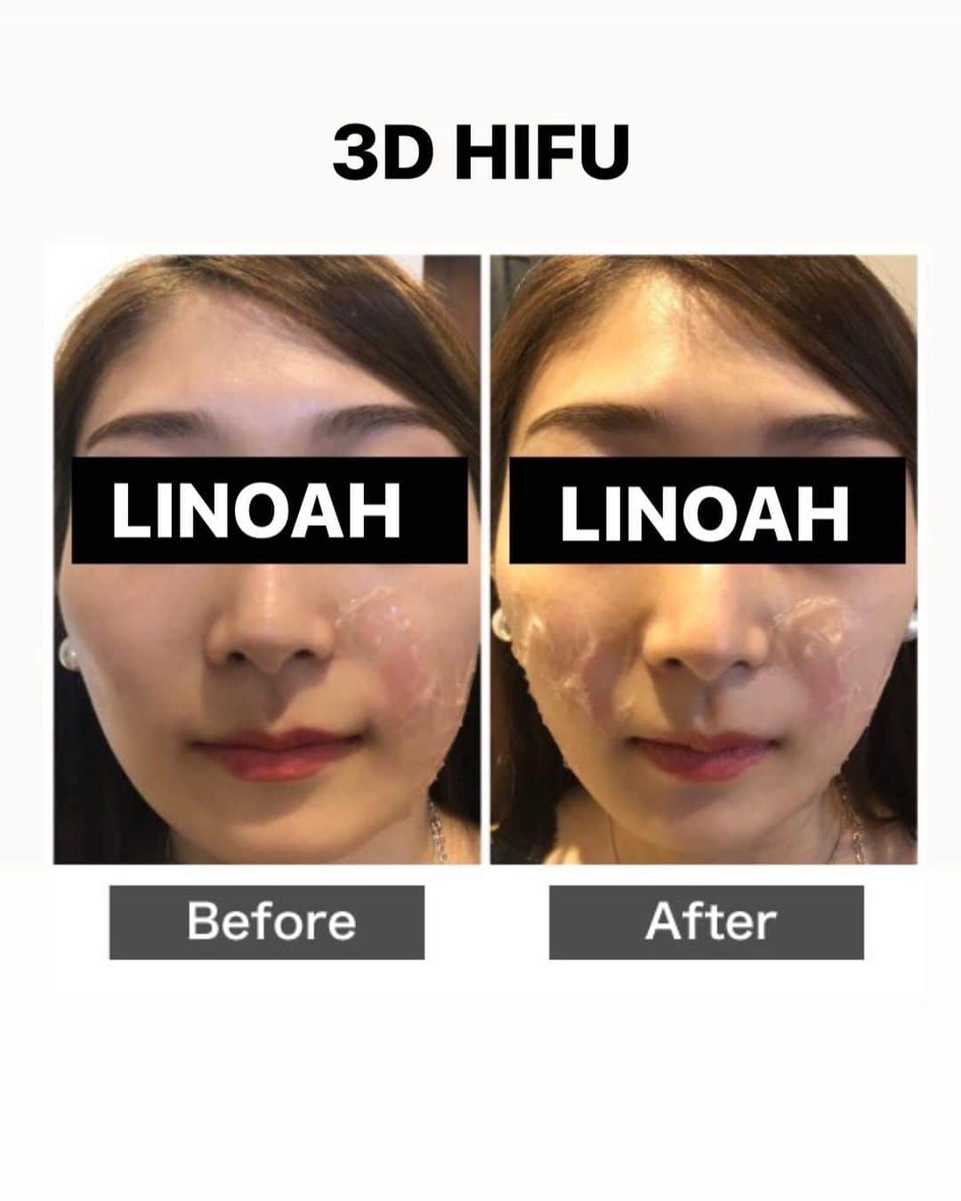 Beauty Salon LINOAHさんのインスタグラム写真 - (Beauty Salon LINOAHInstagram)「・﻿ 本日は【新メニュー】3D HIFUについてのご案内です。﻿ ﻿ 切らないリフトアップとも言われているHIFUは皆さんご存知でしょうか？﻿ ﻿ HIFU（ハイフ）とは高密度焦点照射式超音波治療（High Intensity Focused Ultrasound）の頭文字をとった略語です。﻿ ﻿ 高密度とはハイパワーのこと。﻿ ﻿ 焦点照射式とは、周囲にダメージを与えないということです。﻿ ﻿ つまり強力で周囲にダメージを与えない超音波で、切らないで腫れないお顔のフェイスアップをする施術ということです。﻿ ﻿ 皮膚の下だけに特殊超音波が作用し、切らない腫れないフェイスリフトを実現させます。﻿ ﻿ HIFU（ハイフ）には旧世代と新世代があります。﻿ 旧世代のHIFU（ハイフ）は線照射（２Ｄ）で照射に当てむらが起こります。﻿ ﻿ そのため効果が弱く、多少のリフトアップ効果しかありませんでした。﻿ ﻿ ※正確には線照射は１Ｄです。ですが深さを変えて照射することにより２Ｄ効果がでます。﻿ ﻿ ここでは分かりやすく２Ｄと表現致します。﻿ ﻿ 新世代HIFU（ハイフ）は面照射（３Ｄ）で、均一に照射でき、効果が強く、強力なリフトアップ効果と小顔効果を発揮します。﻿ ﻿ パワフルになった分、小顔効果が発揮できるわけです。﻿ ﻿ 3D HIFU（ハイフ）の相場は他店で受けると﻿ 1回30000円～40000円と高額です。﻿ ﻿ 当店ではこちらの﻿ ３D HIFU（ハイフ）がモニターキャンペーンで 1回5000円でお受け頂けます！！﻿ ﻿ ご興味がある方は是非、ご予約お問い合わせいただければと思います。﻿ ﻿ ﻿ 脱毛・フェイシャルBeautySalon　LINOAH　　　　　　　　﻿ 大阪梅田の脱毛・フェイシャル完全予約制のプライベートサロン　　﻿ 男女　性別問わずご利用頂けます。﻿  ﻿  ﻿ 【アクセス】﻿  ﻿ 大阪市北区鶴野町4-11　朝日プラザ914﻿ 阪急 梅田駅茶屋町口 徒歩 5分﻿  ﻿ 【営業時間】﻿ 平日　11:00～22:00（最終受付21：30）﻿ 土日祝　11:00～20:00（最終受付19：30）﻿ ※完全予約制となっております。﻿  ﻿ 【定休日】﻿ 毎週木曜日﻿  ﻿ ご予約はこちらへ﻿ 電話：06-6110-5067 ﻿ ﻿ ﻿ #大阪 #梅田 #脱毛 #メンズ脱毛 ﻿ #レディース脱毛 #フェイシャル #エステ #beautysalonlinoah ﻿ #ビューティーサロンリノア ﻿ #プライベートサロン ﻿ #フォトフェイシャル ﻿ #男性 #女性 #lgbt ﻿ #安心 #美肌 #美白 #しみ #シワ ﻿ #ニキビ #ニキビ跡 ﻿ #リフトアップ #小顔 #ハイフ#HIFU﻿ #ヒゲ #顔 #青ひげ #カミソリ負け #美意識 ﻿ ﻿」8月5日 0時06分 - beautysalon_linoah