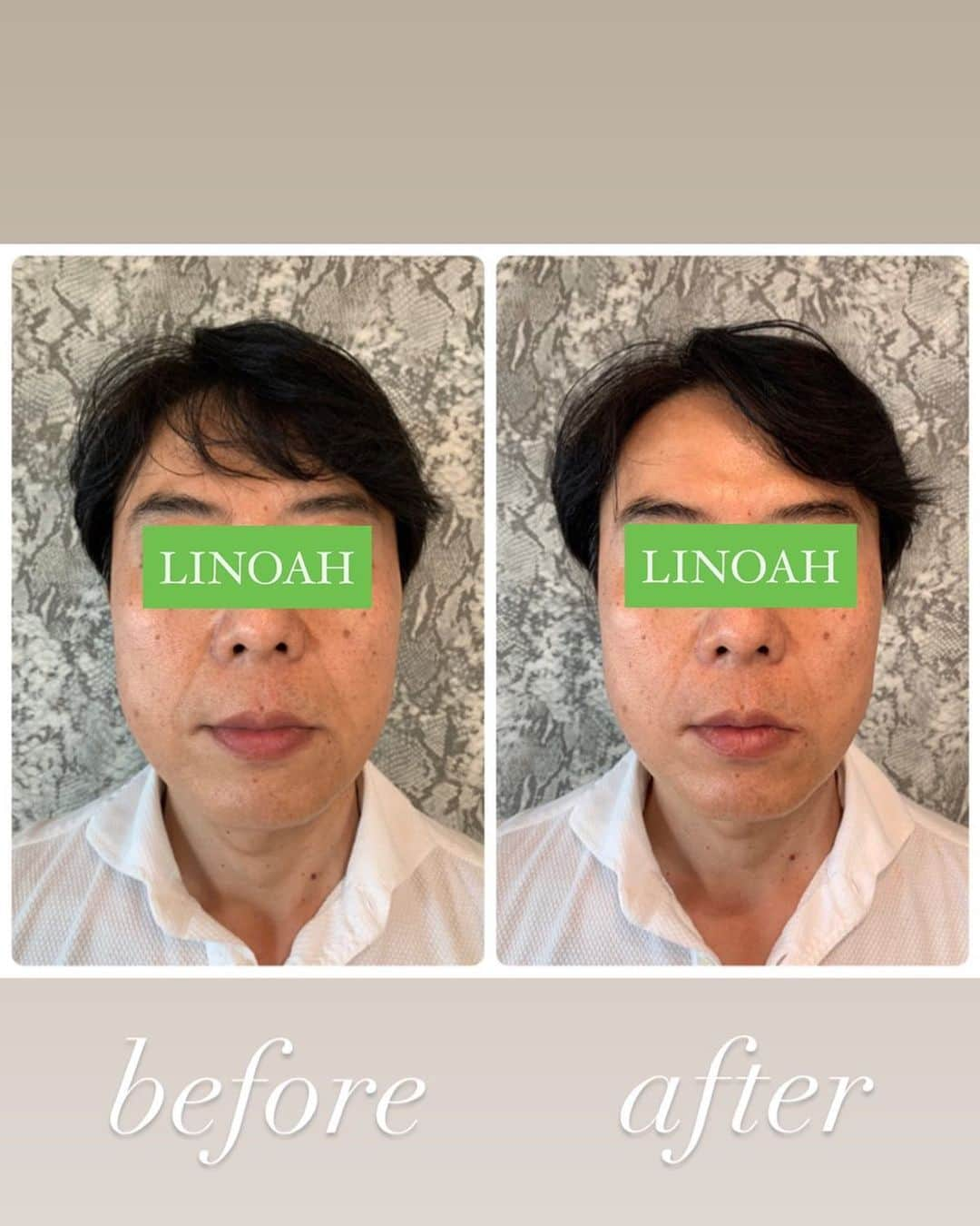 Beauty Salon LINOAHさんのインスタグラム写真 - (Beauty Salon LINOAHInstagram)「３D HIFU（ハイフ）﻿ ⭐️モニターキャンペーン募集中⭐️﻿ 1回5000でお受け頂けます！！﻿ ﻿ ご興味がある方は是非、ご予約お問い合わせいただければと思います。﻿ ﻿ ﻿ 脱毛・フェイシャルBeautySalon　LINOAH　　　　　　　　﻿ 大阪梅田の脱毛・フェイシャル完全予約制のプライベートサロン　　﻿ 男女　性別問わずご利用頂けます。﻿  ﻿  ﻿ 【アクセス】﻿  ﻿ 大阪市北区鶴野町4-11　朝日プラザ914﻿ 阪急 梅田駅茶屋町口 徒歩 5分﻿  ﻿ 【営業時間】﻿ 平日　11:00～22:00（最終受付21：30）﻿ 土日祝　11:00～20:00（最終受付19：30）﻿ ※完全予約制となっております。﻿  ﻿ 【定休日】﻿ 毎週木曜日﻿  ﻿ ご予約はこちらへ﻿ 電話：06-6110-5067 ﻿ ﻿ ﻿ #大阪 #梅田 #脱毛 #メンズ脱毛 ﻿ #レディース脱毛 #フェイシャル #エステ #beautysalonlinoah ﻿ #ビューティーサロンリノア ﻿ #プライベートサロン ﻿ #フォトフェイシャル ﻿ #男性 #女性 #lgbt ﻿ #安心 #美肌 #美白 #しみ #シワ ﻿ #ニキビ #ニキビ跡 ﻿ #リフトアップ #小顔 #ハイフ#HIFU﻿ #ヒゲ #顔 #青ひげ #カミソリ負け #美意識 ﻿ ﻿」8月5日 0時14分 - beautysalon_linoah