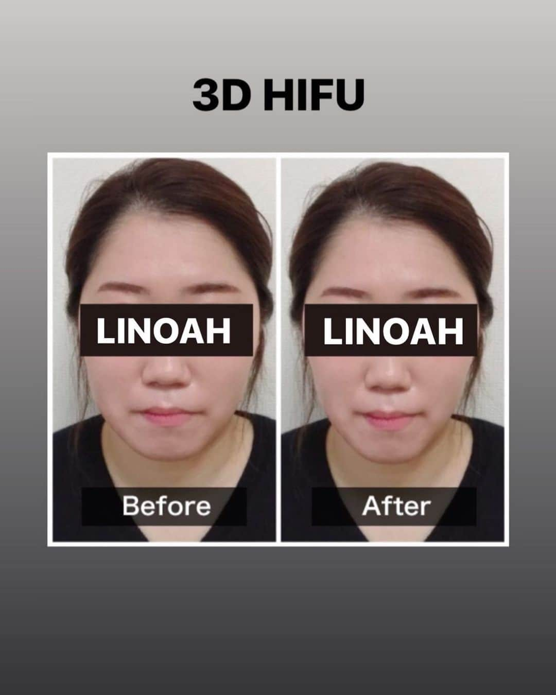 Beauty Salon LINOAHさんのインスタグラム写真 - (Beauty Salon LINOAHInstagram)「３D HIFU（ハイフ）﻿ ⭐️モニターキャンペーン募集中⭐️﻿ 1回5000でお受け頂けます！！﻿ ﻿ ご興味がある方は是非、ご予約お問い合わせいただければと思います。﻿ ﻿ ﻿ 脱毛・フェイシャルBeautySalon　LINOAH　　　　　　　　﻿ 大阪梅田の脱毛・フェイシャル完全予約制のプライベートサロン　　﻿ 男女　性別問わずご利用頂けます。﻿  ﻿  ﻿ 【アクセス】﻿  ﻿ 大阪市北区鶴野町4-11　朝日プラザ914﻿ 阪急 梅田駅茶屋町口 徒歩 5分﻿  ﻿ 【営業時間】﻿ 平日　11:00～22:00（最終受付21：30）﻿ 土日祝　11:00～20:00（最終受付19：30）﻿ ※完全予約制となっております。﻿  ﻿ 【定休日】﻿ 毎週木曜日﻿  ﻿ ご予約はこちらへ﻿ 電話：06-6110-5067 ﻿ ﻿ ﻿ #大阪 #梅田 #脱毛 #メンズ脱毛 ﻿ #レディース脱毛 #フェイシャル #エステ #beautysalonlinoah ﻿ #ビューティーサロンリノア ﻿ #プライベートサロン ﻿ #フォトフェイシャル ﻿ #男性 #女性 #lgbt ﻿ #安心 #美肌 #美白 #しみ #シワ ﻿ #ニキビ #ニキビ跡 ﻿ #リフトアップ #小顔 #ハイフ#HIFU﻿ #ヒゲ #顔 #青ひげ #カミソリ負け #美意識 ﻿ ﻿」8月5日 0時14分 - beautysalon_linoah