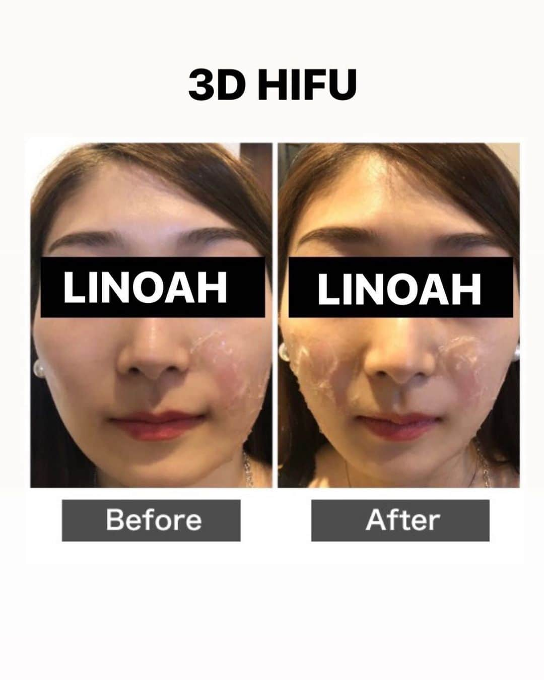 Beauty Salon LINOAHさんのインスタグラム写真 - (Beauty Salon LINOAHInstagram)「３D HIFU（ハイフ）﻿ ⭐️モニターキャンペーン募集中⭐️﻿ 1回5000でお受け頂けます！！﻿ ﻿ ご興味がある方は是非、ご予約お問い合わせいただければと思います。﻿ ﻿ ﻿ 脱毛・フェイシャルBeautySalon　LINOAH　　　　　　　　﻿ 大阪梅田の脱毛・フェイシャル完全予約制のプライベートサロン　　﻿ 男女　性別問わずご利用頂けます。﻿  ﻿  ﻿ 【アクセス】﻿  ﻿ 大阪市北区鶴野町4-11　朝日プラザ914﻿ 阪急 梅田駅茶屋町口 徒歩 5分﻿  ﻿ 【営業時間】﻿ 平日　11:00～22:00（最終受付21：30）﻿ 土日祝　11:00～20:00（最終受付19：30）﻿ ※完全予約制となっております。﻿  ﻿ 【定休日】﻿ 毎週木曜日﻿  ﻿ ご予約はこちらへ﻿ 電話：06-6110-5067 ﻿ ﻿ ﻿ #大阪 #梅田 #脱毛 #メンズ脱毛 ﻿ #レディース脱毛 #フェイシャル #エステ #beautysalonlinoah ﻿ #ビューティーサロンリノア ﻿ #プライベートサロン ﻿ #フォトフェイシャル ﻿ #男性 #女性 #lgbt ﻿ #安心 #美肌 #美白 #しみ #シワ ﻿ #ニキビ #ニキビ跡 ﻿ #リフトアップ #小顔 #ハイフ#HIFU﻿ #ヒゲ #顔 #青ひげ #カミソリ負け #美意識 ﻿ ﻿」8月5日 0時15分 - beautysalon_linoah