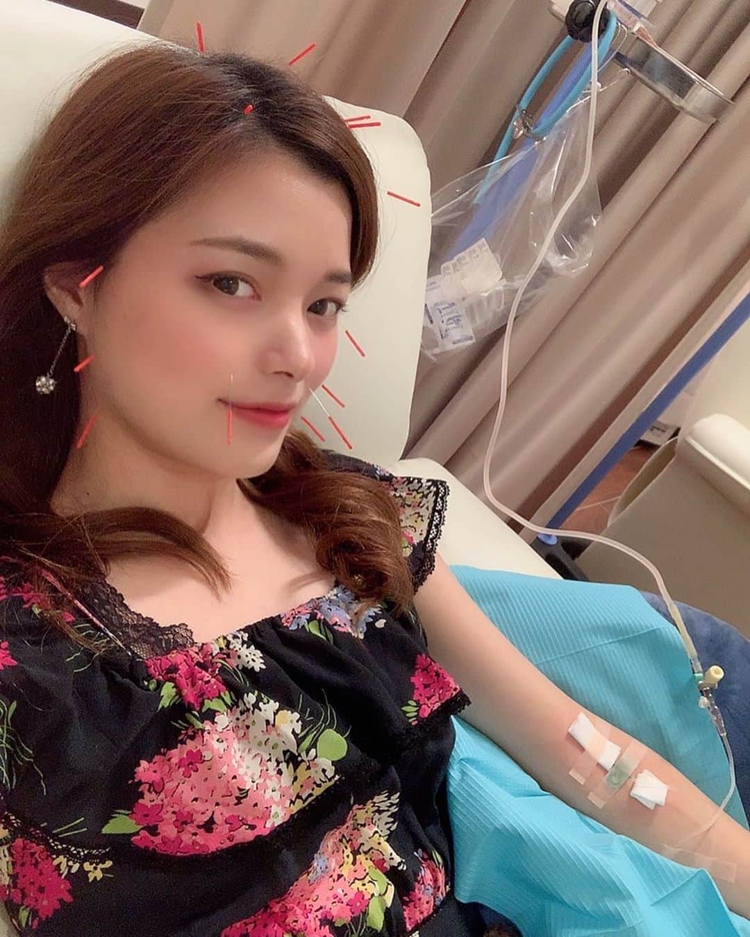 Laraのインスタグラム：「【 Drip beauty clinic 💉✖️大口先生 🥳👐🏻】 まさかのコラボしてもらった🤩👏🏻🌈💖  クリニックで血液クレンジングとビタミンいれてもらいました🍋😚🌟❥︎:❥︎🔫  一気に🤩😍痛くなくて一瞬で引き上げられて小顔に🥺❗️💖スッキリ٩( ᐛ )و✨💕👏🏻  流石大口先生のゴットハンド👐🏻👄🔥🔥 凄い人にしてもらえるなんて…😭💘  針刺すところ見ると 痛くないのにやっぱりこわいね🤣🤣💉  ありがとうございました(⁎›௰‹⁎)ෆ⃛  #dripbeautyclinic #大口貴弘 先生 #美容 #血液クレンジング #ビタミン点滴  #小顔矯正 #針治療 #美容鍼 #ゴットハンド #大口式小顔矯正 #下過ぎるアングルで顔やばい HAHAHA」