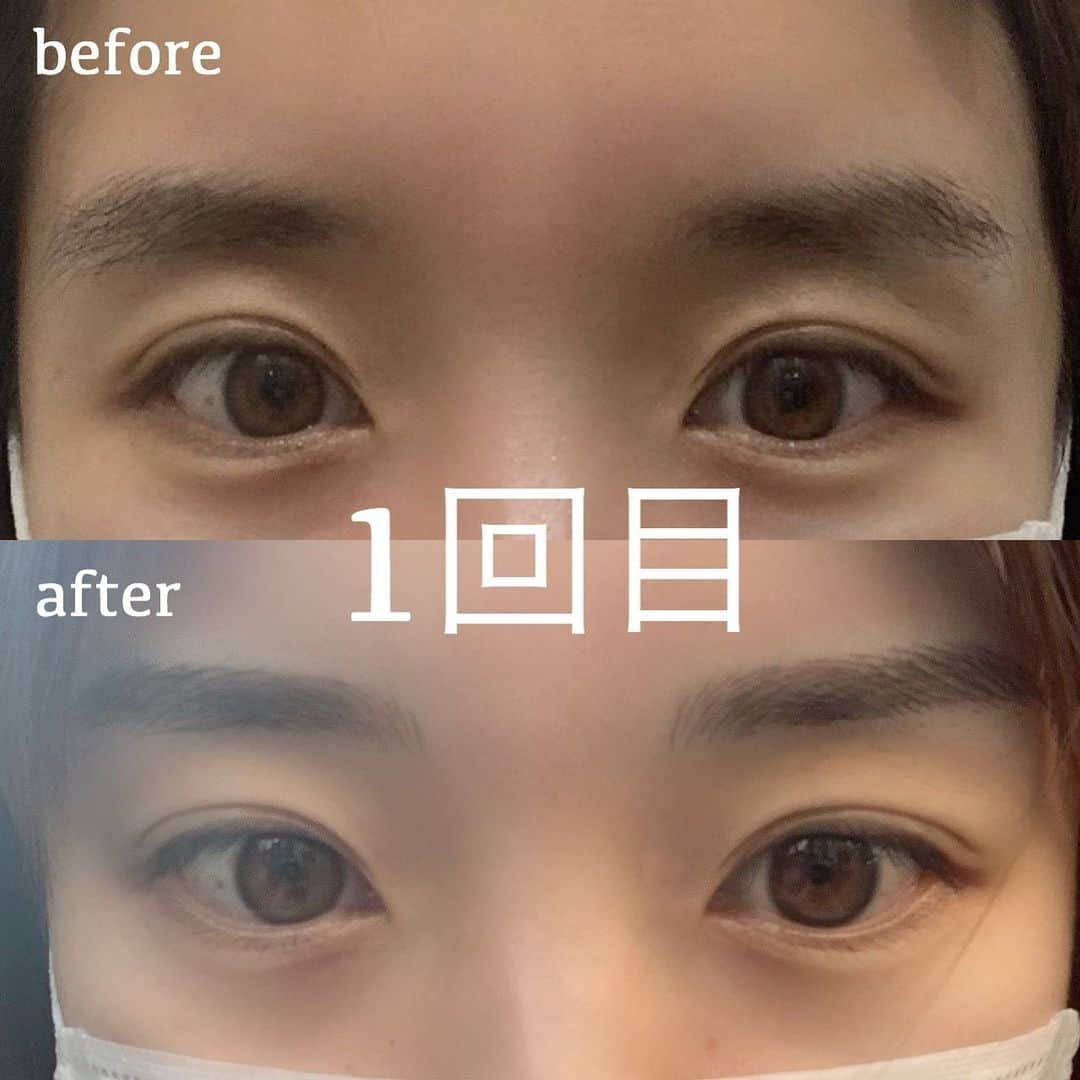 田畑佑莉さんのインスタグラム写真 - (田畑佑莉Instagram)「@medicalbrows さんにて2回目のアートメイク施術していただきました✒︎（動画あり.また珍しく長文📝）   ︎ アートメイクは個人差がありますが、長持ちする人は一回で3年持つ方も。 　  なりたい眉毛・自分の顔にとっての黄金比・顔のバランスに合った眉がスッピンでも定着させる4Dならぬ6Dという技術。 パッと出かける時もリップだけ塗れば出かけれるのがほんっとに嬉しい🤎 明るいブラウンでアートしていただいたので本当に自然✨  アートメイクには施術者にもランクがあり、 多くの芸能人を担当するマスタートレイナーというランク以上の方に担当していただきました👑 （技術・施術症例数・指名回数・接遇等の総合的観点から推薦を受け、更にMedicalbrows Master Trainer認定試験に通過した方。） 担当の吉田さん（@medicalbrows_moe）にカウンセリングから施術していただきました！ そして吉田さんがniziproミイヒちゃんすぎて可愛い笑👏✨  朝の準備が本当に楽だし、 目と眉は特に目がいくし顔の印象を大きく変えるものだと思います✨今の時期、マスク生活ですし特に目が行きますね✨  眉で顔の印象が大きく変わるし、一度アートをやったらなかなか取れない。（万が一、失敗したら毎日絶望🙄） だからこそ信頼できるサロン、施術者の施術をおすすめします。  やりたい方、前から気になっていた方はぜひ検討してみてください❤︎」8月5日 19時59分 - lily02tbt