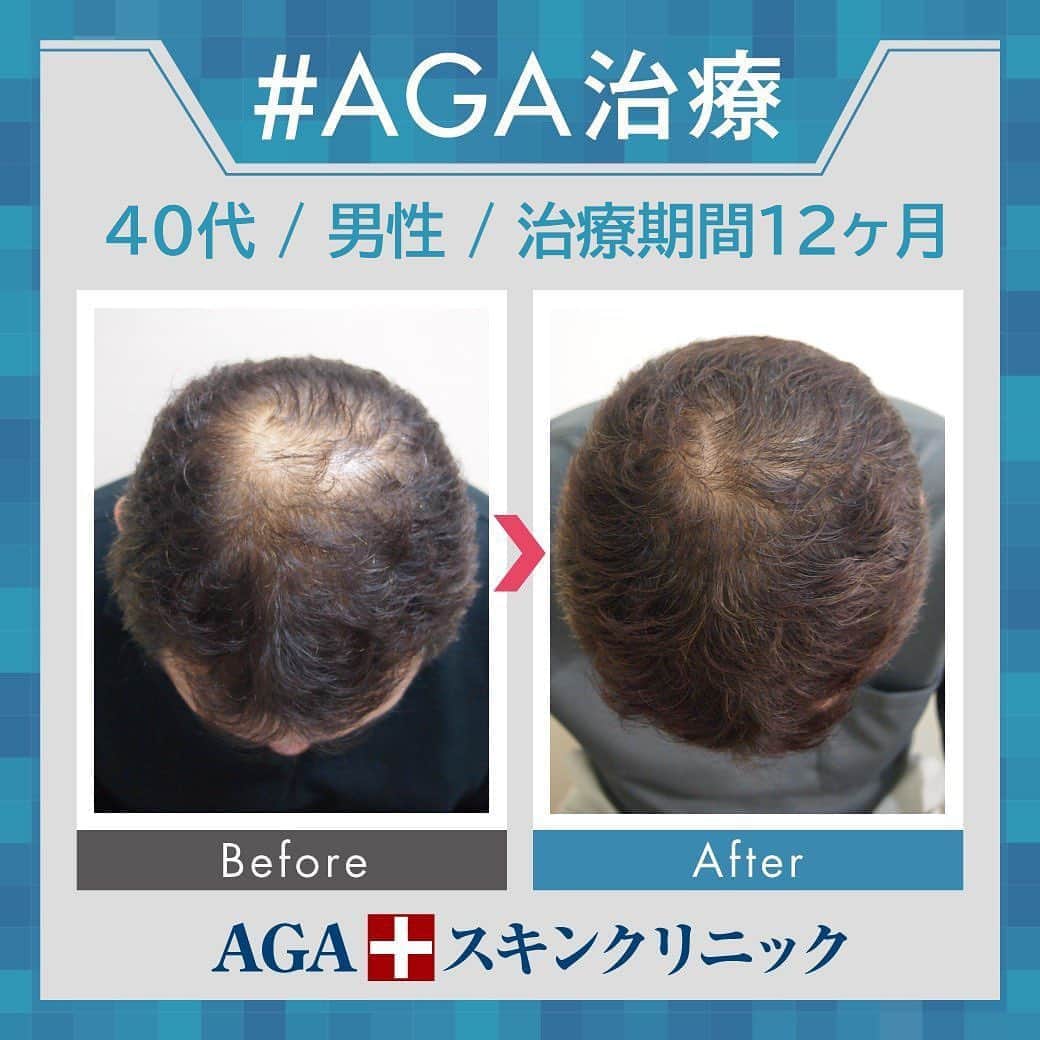 【公式】AGAスキンクリニックさんのインスタグラム写真 - (【公式】AGAスキンクリニックInstagram)「⭐️AGAスキンクリニック　Before⇒After⭐️ . 〇40代男性のケース 〇治療期間12か月 〇内容 ⇒オリジナル発毛薬 ⇒Dr'sメソ治療（AGA メソセラピー） . 頭頂部の薄毛が目立たなくなりました❣ 治療前よりも若々しさが出てきてます👏 . AGAは早期治療が肝心です。 クリニックなど詳細は、@aga_clinic より公式HPをチェックしてみてください🥰 . . #AGAスキンクリニック #AGA #男性型脱毛症 #AGA治療 #薄毛 #薄毛治療 #抜毛 #発毛 #育毛 #治療 #薬 #ミノキシジル #AGAスキンクリニック症例 #男性ホルモン #フィナステリド #デュタステリド #初期脱毛 #美容男子 #髪質改善 #頭皮ケア」8月8日 11時09分 - aga_clinic