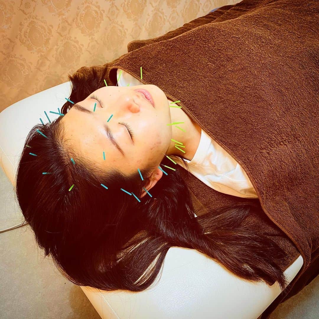 のインスタグラム：「. オープンキャンパスで美容鍼体験もやってます💓  在学生が来てくれました😊  テスト勉強で疲れた方などにもオススメ✨✨  #大阪医療技術学園専門学校  #ocmt #鍼灸美容学科 #美容 #美容鍼  #大阪エステ　#サロン #オープンキャンパス　#2020 #instalike #instagram #instagood」