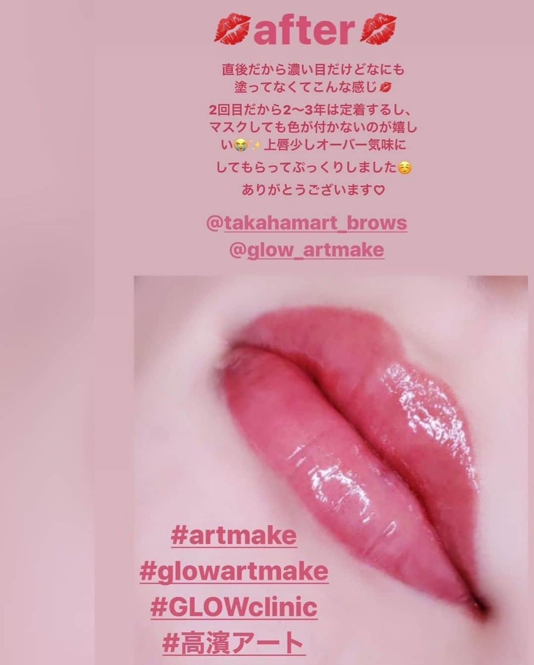 山内あいなさんのインスタグラム写真 - (山内あいなInstagram)「2回目の唇のアートメイク後﻿ 1週間くらい経ったよ💋💋﻿ ワセリンしか塗ってない写真💄﻿ ﻿ マスクをしても裏側にリップの色が付かないし、2回目で定着してきたので2〜3年はこの血色の良い自然な唇の色なので嬉しいな☺️✨✨﻿ ﻿ アートメイクなので正直ちょっぴり痛いけど塗る麻酔をしてもらって調節もできるので安心でした💭﻿ ﻿ 担当のたかはまさん @takahamart_brows とそのあとのお寿司屋さんへ、、幸せすぎた🍣😫﻿ 西麻布にある素敵な大将さんのお店で、インスタも開設されたばかりなので見てみてね☺️ @sushi.miyazono ﻿ ﻿ ﻿ ﻿ #artmake﻿ #glowartmake﻿ #GLOWclinic﻿ #lip﻿ #高濱アート﻿ #お寿司 ﻿ #sushi」8月9日 16時31分 - ainayamauchi3131