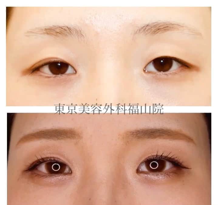 東京美容外科公式のインスタグラム：「こんにちは✨ 🌹東京美容外科福山院です🌹 . 顔の印象の9割は目元で決まります🥰 自然なデザインも可能です✨ . 写真上:術前 写真下:1カ月後 . 自然にパッチリお目元になりましたね😊 ※腫れ、内出血には個人差がございます。 . ⚠️リスク 内出血、腫れ、左右左 . カウンセリングは無料です🆓 お気軽にお越し下さいませ❣️ . 【東京美容外科】 ====□お問い合わせはこちら□===== ▼フリーダイヤル ☎0120-658-958 （コールセンター受付時間：9：00～21：00） . ▼LINE予約 @ tkc110 ============== #東京美容外科#福山#オルチャンリフト#ニキビ肌#汗管腫#綺麗#beautiful#二重#プチ#kawaii#コンプレックス #アイプチ#卒業#キャンペーン#モデル#モニター#目力#美容#美意識#女子力#可愛い#美白ケア#唇#プルプル#ラシャスリップス #美容クリニック」