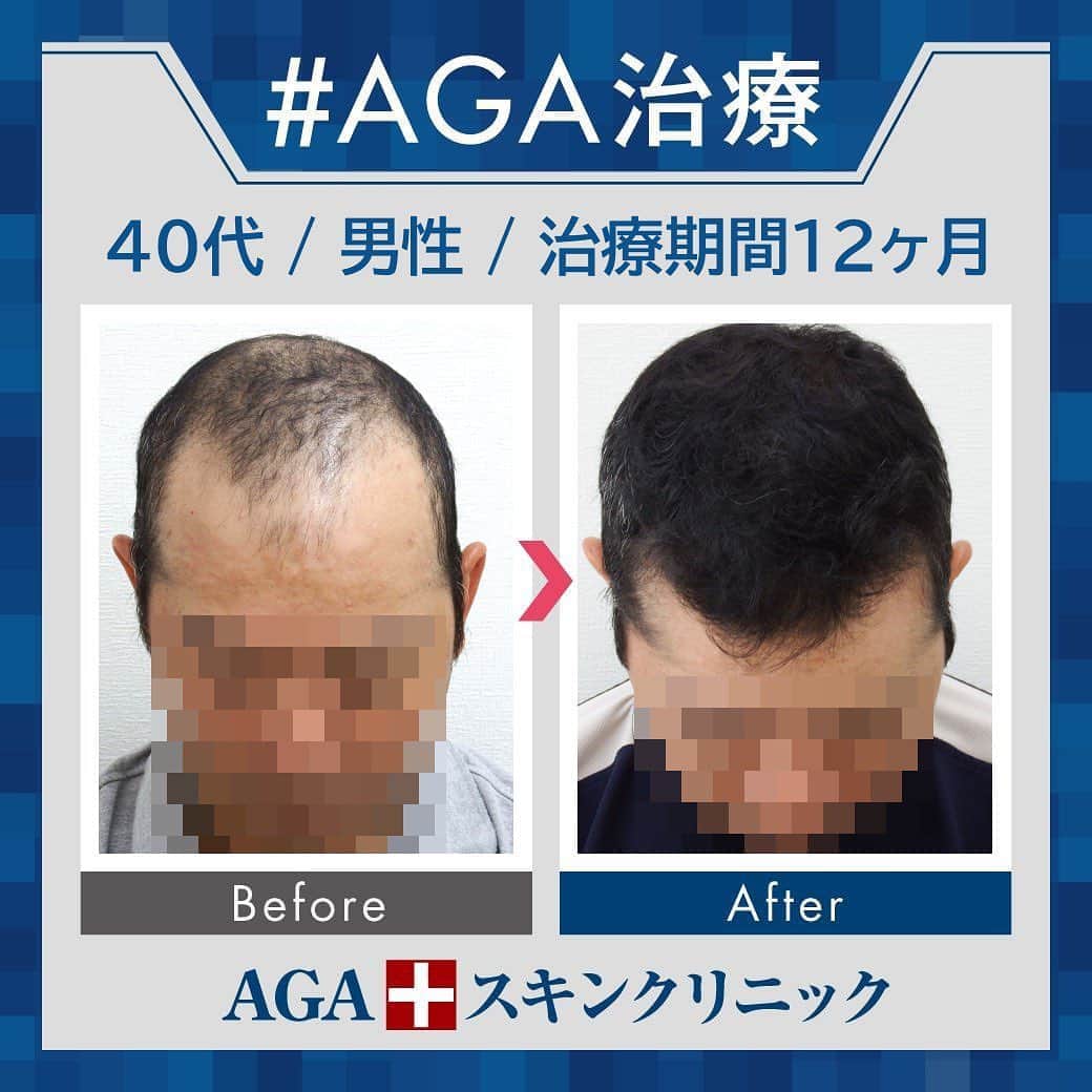 【公式】AGAスキンクリニックさんのインスタグラム写真 - (【公式】AGAスキンクリニックInstagram)「⭐️AGAスキンクリニック　Before⇒After⭐️ . 〇40代男性のケース 〇治療期間12か月 〇内容 ⇒オリジナル発毛薬 ⇒Dr'sメソ治療（AGA メソセラピー） . 全体的な毛量の変化が一目瞭然ですね😲❣ 黒くてしっかりした毛髪がしっかり生えそろいました☺ 一年間の治療、お疲れ様でした👏 . AGAは早期治療が肝心です。 クリニックなど詳細は、@aga_clinic より公式HPをチェックしてみてください🥰 . . #AGAスキンクリニック #AGA #男性型脱毛症 #AGA治療 #薄毛 #薄毛治療 #抜毛 #発毛 #育毛 #治療 #薬 #ミノキシジル #AGAスキンクリニック症例 #男性ホルモン #フィナステリド #デュタステリド #初期脱毛 #美容男子 #髪質改善 #頭皮ケア」8月11日 18時03分 - aga_clinic