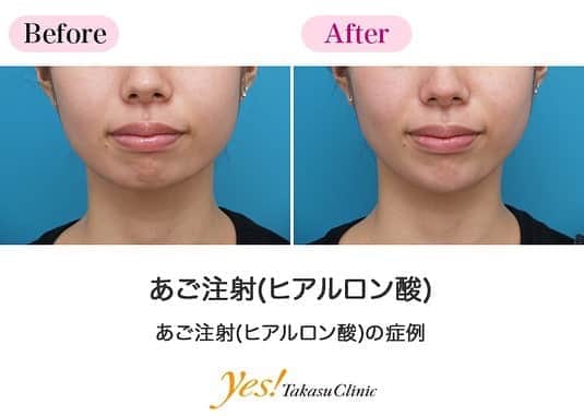 高須クリニックのインスタグラム：「👨🏻‍⚕️高須幹弥医師からのコメント✨⠀ 20代の女性です。手軽にあごを整えたいということで、ヒアルロン酸を2本（2cc）注入しました。施術中に鏡で確認しながら注入していくので、その場での微調整も可能。丁寧な注入で、引っ込んでいたあごがEライン上に出て、どの角度から見ても美しく仕上がりました。 ヒアルロン酸注入は、プロテーゼをする前に体験しておくこともご提案しています。ヒアルロン酸を注入し、あごが変ると顔全体にどう影響するのかを確認できます。 ---------------------------------------------------- 🌈料金✨⠀ ●あご注射（ヒアルロン酸） ヒアルロン酸 ¥50,000 / 長期持続型ヒアルロン酸注射シャープラインジョウ ¥150,000【全院】 ---------------------------------------------------- ⚠️リスク・副作用・合併症✨⠀ ●あご注射（ヒアルロン酸） 内出血（注射針が血管に当たってしまった場合） 仕上がりのわずかな左右差（完璧なシンメトリーは不可） 仕上がりが完璧に自分の理想の形にならないことがある アレルギーが生じる可能性 注入後の感染 過度にいじったり揉んだりすると腫れる可能性 --------------------------------------------------- 😊施術についての詳細✨⠀⠀ https://www.takasu.co.jp/photo/agochu19.html ---------------------------------------------------- 📞ご予約・お問い合わせ✨⠀ 0120-5587-10⠀ https://www.takasu.co.jp/cgi-bin/form/contact.cgi ※症例写真や施術に関するご質問なども上記までお願い致します。 ---------------------------------------------------- #顎 #顎を出したい #あご注射 #顎のヒアルロン酸注射 #あごを整えたい #顎整形 #皮膚 #美容 #美肌 #エイジングケア #美容整形 #美容外科 #美容クリニック #美容好き #美容皮膚科 #モニター #モニター募集 #高須クリニック #高須クリニック名古屋 #高須幹弥 #整形したい #プチ整形 #症例 #症例写真 #可愛くなりたい #可愛い #美人」