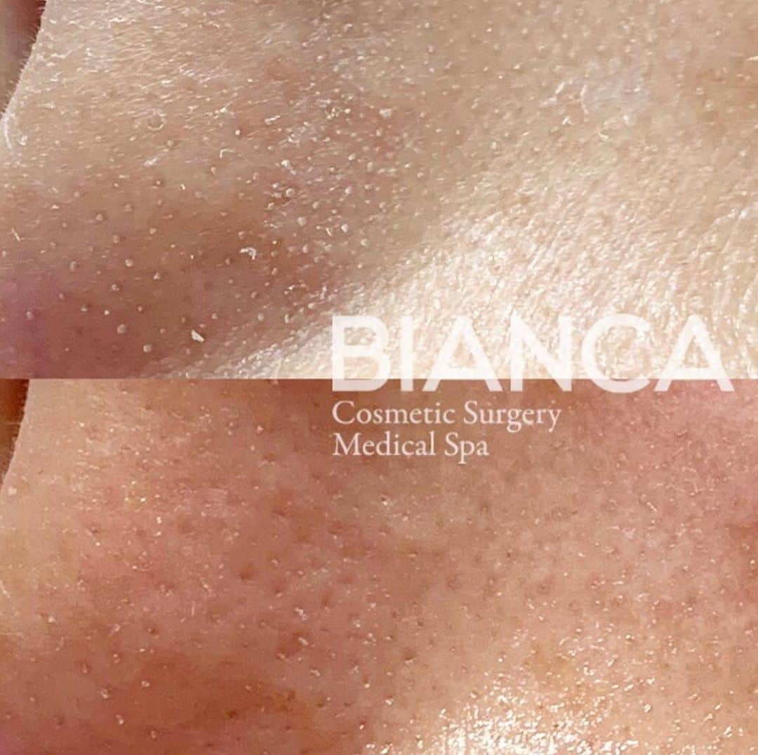 のインスタグラム：「【毛穴の汚れを徹底除去‼️】﻿ ﻿ 上　施術前﻿ 下　1回施術後﻿ ﻿ BIANCAはHydrafacial症例数日本一🏆🥇🗻✨﻿ ﻿ 特許取得の技術である🌪水流🌪の力を利用してお肌に美容成分を補給しながら、その美容成分を含んだ水流で汚れを排出することによって、余分な皮脂や角質の除去と同時にクレンジングや保湿を行うことができます♻️✨﻿ ﻿ ⚠️最近は"ハイドラ〜"という模造品が多く出回っているのでお気をつけ下さい。﻿ 効果も全く違いますので、ご注意ください🥺﻿ ﻿ ☑️HydraFacial MD﻿ ♻️毛穴の汚れ・角質除去・肌質改善﻿ 💴 19,800円 / 回﻿ 💉麻酔: なし﻿ 😷DT: なし﻿ ﻿ ⚠️ご予約の際は﻿ 『Dr Yuu（辻沢）のインスタ見た』の一言をお願いします👩‍⚕️✨﻿ ﻿ 📍BIANCA CLINIC﻿ ✔︎銀座院﻿ 03-6263-2690 ﻿ 東京都中央区銀座1-5-6 銀座レンガ通り福神ビル 4F﻿ 診療時間 10:00～19:00﻿ 年中無休（年末年始を除く）﻿ ﻿ 9月勤務日🎑﻿ 表参道院﻿ ↪︎1 3 6 14 16 19 21 24 27 30﻿ 銀座院﻿ ↪︎2 5 17 18 20 22 25 26﻿ ﻿ #bianca #plasticsurgery #cosmeticsurgery #beauty #美容外科 #美容皮膚科 #美容整形 #プチ整形 #美肌 #美魔女 #美容 #アンチエイジング #ビューティー #hydrafacial #ハイドラフェイシャル #ピーリング #スキンケア #毛穴 #毛穴ケア #毛穴レス #biancaclinic #ビアンカクリニック」
