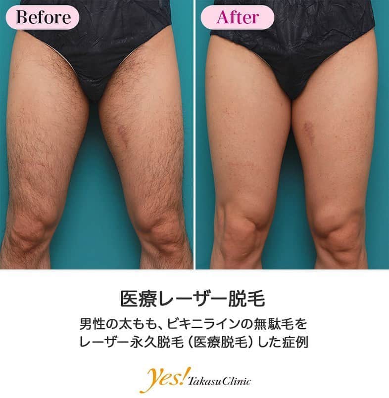 高須クリニックのインスタグラム：「👨🏻‍⚕️高須幹弥医師からのコメント✨⠀ 30代男性の患者様で、太ももの無駄毛を気にされていました。 短パンや海パンをはいて脚を出したときに、女の子から、「毛深いねー」と言われたことがショックで、レーザー医療脱毛することを決意したとのことでした。 診察させていただいたところ、太ももの前面、後面、ビキニラインにびっしりと剛毛が生えていました。 治療は、2ヶ月以上空けて、繰り返しレーザーを当てていきました。 レーザーを当てる度に毛は薄くなっていき、8回照射後には、かなりの毛がなくなったため、治療を終了しました。 永久脱毛であるため、エステの脱毛のように、時間が経つとまた毛が生えてくることはもちろんありません。 最近の若い女性は、「すべすべの綺麗な肌の男性が好き」という人は多いですが、「毛深い男性が好き」という人はほとんどいないため、毛深くて損をすることがあっても、得をすることはあまりありません。 どれだけ体を清潔にして、綺麗な服を着ていても、毛深いというだけで、女性から、「不潔そうに見える」言われてしまうことはあるので、毛深くて悩んでいる人にはレーザー医療脱毛で永久脱毛をご検討ください。 ---------------------------------------------------- 🌈料金✨⠀ ●医療レーザー脱毛　太腿（両脚・ひざ半分含む） 初回~5回目までの1回毎 ¥50,000（女性）　¥60,000（男性） / 1年間フリープラン ¥250,000（女性）　¥300,000（男性）【全院】 ※「1年間フリープラン」は上限8回までの施術とさせていただきます。 ●医療レーザー脱毛　ビキニライン（広範囲）　女性のみ 初回~5回目までの1回毎 ¥40,000 / 1年間フリープラン ¥200,000【全院】 ※「1年間フリープラン」は上限8回までの施術とさせていただきます。 ●医療レーザー脱毛　ビキニライン（中範囲）　女性のみ 初回~5回目までの1回毎 ¥30,000 / 1年間フリープラン ¥150,000【全院】 ※「1年間フリープラン」は上限8回までの施術とさせていただきます。 ●医療レーザー脱毛　ビキニライン（小範囲）　女性のみ 初回~5回目までの1回毎 ¥20,000【全院】 / 1年間フリープラン ¥100,000【全院】 ※「1年間フリープラン」は上限8回までの施術とさせていただきます。 ---------------------------------------------------- ⚠️リスク・副作用・合併症✨⠀ ●医療レーザー脱毛 肌のほてり・発赤（照射後／肌が弱い方・敏感肌の方） 日焼けした肌に脱毛レーザーを照射すると火傷のリスク 照射後間もない時期に日焼けをすると、シミや色素沈着 一時的な毛嚢炎 --------------------------------------------------- 😊施術についての詳細✨⠀⠀ https://www.takasu.co.jp/photo/epi10.html ---------------------------------------------------- 📞ご予約・お問い合わせ✨⠀ 0120-5587-10⠀ https://www.takasu.co.jp/cgi-bin/form/contact.cgi ※症例写真や施術に関するご質問なども上記までお願い致します。 ---------------------------------------------------- #医療レーザー脱毛 #レーザー永久脱毛 #医療脱毛 #太ももの無駄毛 #ビキニライン  #皮膚 #美容 #美肌 #エイジングケア #美容整形 #美容外科 #美容クリニック #美容好き #美容皮膚科 #モニター #モニター募集 #高須クリニック #高須クリニック名古屋 #高須幹弥 #整形したい #プチ整形 #症例 #症例写真 #可愛くなりたい #可愛い #美人」