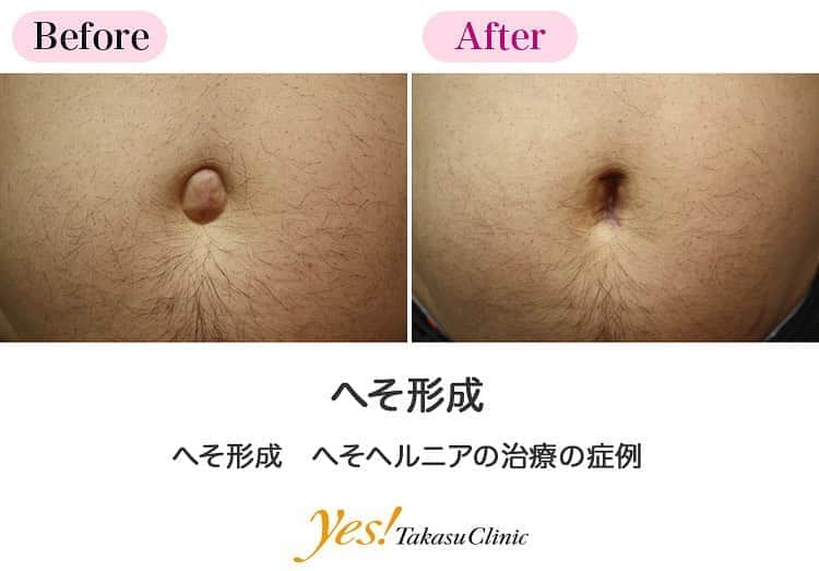 高須クリニックのインスタグラム：「👨🏻‍⚕️高須幹弥医師からのコメント✨⠀ へそヘルニアを患っていた方です。おへその表面のふくらみを取り除き、縫い合わせることでヘルニアを根治。再発防止にもなります。また手術をすることで、見た目にもすっきりした形のおへそになりました。 ---------------------------------------------------- 🌈料金✨⠀ ●へそ形成 単純に出ベソを切除縫縮する場合 ¥150,000 / ヘソヘルニアや複雑な手術になる場合 ¥200,000~300,000【東京、横浜、名古屋、大阪】 ---------------------------------------------------- ⚠️リスク・副作用・合併症✨⠀ ●へそ形成 手術後に処方する抗生剤や痛みどめによるアレルギー症状 仕上がりのわずかな左右差（完璧なシンメトリーは不可） 仕上がりが完璧に自分の理想の形にならないことがある 傷跡が肥厚性瘢痕やケロイドになる可能性 --------------------------------------------------- 😊施術についての詳細✨⠀⠀ https://www.takasu.co.jp/photo/navel_04.html ---------------------------------------------------- 📞ご予約・お問い合わせ✨⠀ 0120-5587-10⠀ https://www.takasu.co.jp/cgi-bin/form/contact.cgi ※症例写真や施術に関するご質問なども上記までお願い致します。 ---------------------------------------------------- #へそ形成 #へそヘルニア #へそヘルニアの治療 #へそヘルニアの再発防止 #すっきりした形のおへそ  #皮膚 #美容 #美肌 #エイジングケア #美容整形 #美容外科 #美容クリニック #美容好き #美容皮膚科 #モニター #モニター募集 #高須クリニック #高須クリニック名古屋 #高須幹弥 #整形したい #プチ整形 #症例 #症例写真 #可愛くなりたい #可愛い #美人」