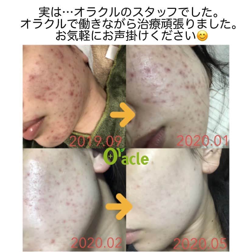 オラクル美容皮膚科東京新宿院さんのインスタグラム写真 - (オラクル美容皮膚科東京新宿院Instagram)「実は…こちらの動画症例は﻿ オラクルスタッフの治療経過です。﻿ ﻿ 2019年にオラクルのスタッフに仲間入りしてから﻿ ニキビ治療を頑張っておりました。﻿ 現在はニキビはほぼなくなり、ニキビ跡の治療を頑張っています。﻿ ﻿ お肌が綺麗になったことで表情も明るくなり笑顔も増えたと周りのスタッフも感じます。﻿ ﻿ 現在も休みの日にもオラクルに来て、患者様に混ざって😅肌をキープするケアをしておりますよ👏﻿ ﻿ 【ニキビ治療内容】﻿ ニキビの根本治療はアグネスとピーリングをメインにいろいろな施術所を試しております。﻿ ぜひ院でもお声掛けください。﻿ ﻿ ☑️アグネス　➡︎皮脂腺を破壊する根本治療﻿ ☑️BHAピーリング➡︎ニキビ治療専用のピーリング﻿ ☑️ダーマペン﻿ ☑️水光注射　など﻿ ﻿ ﻿ ニキビが落ちついてからは﻿ ハイドラフェイシャルもできるようになり、毛穴の詰まり不要な汚れの除去、古い角質の除去でお肌ターンーオーバーを正常にしお肌をキープ中﻿ ﻿ その他にもスキンケアの改善﻿ 以前より保湿を意識して﻿ 紫外線対策など﻿ ﻿ 同じようなニキビの症状でお悩みの方は、お気軽スタッフにお声がけください。﻿ ﻿ ▪️▫️▪️▫️▪️▫️▪️▫️▪️▫️﻿ ﻿ 🇯🇵オラクル美容皮膚科🇰🇷﻿ 📍東京新宿院﻿ 新宿3丁目19-4 MLJ新宿8階﻿ ﻿ 📍名古屋院﻿ 名古屋市中区錦3丁目24−4 サンシャイン栄5階﻿ ﻿ 【専門】﻿ ニキビ（跡）／毛穴／シミ／しわ／たるみ／痩身／アンチエイジング／美白美肌全般／ブライダル相談／メンズ美容﻿ ﻿ 🗝完全予約制﻿ 👠土日祝日も診療﻿ ﻿ 【予約方法】﻿ ☎0120-905-696﻿ ⏰9:00～21:00［年中無休］﻿ ﻿ LINE、メール24時間📧﻿ LINE🆔 @oracle.jp ﻿ 📩HPメールフォームよりお願いいたします﻿ ﻿ ﻿ #オラクル美容皮膚科 #ニキビ　#ニキビ治療 #ニキビ跡　#クレーター肌　#毛穴　#毛穴ケア　#美肌 　#メンズ美容　#美白効果 #トーンアップ  #美容皮膚科 #美容 #美容好き #美容部 #美容好きな人と繋がりたい #美容好き #韓国美容 #韓国 #美容オタク　#アグネス　#メソナJ﻿ #ニキビ跡治療」9月10日 9時32分 - oraclejp