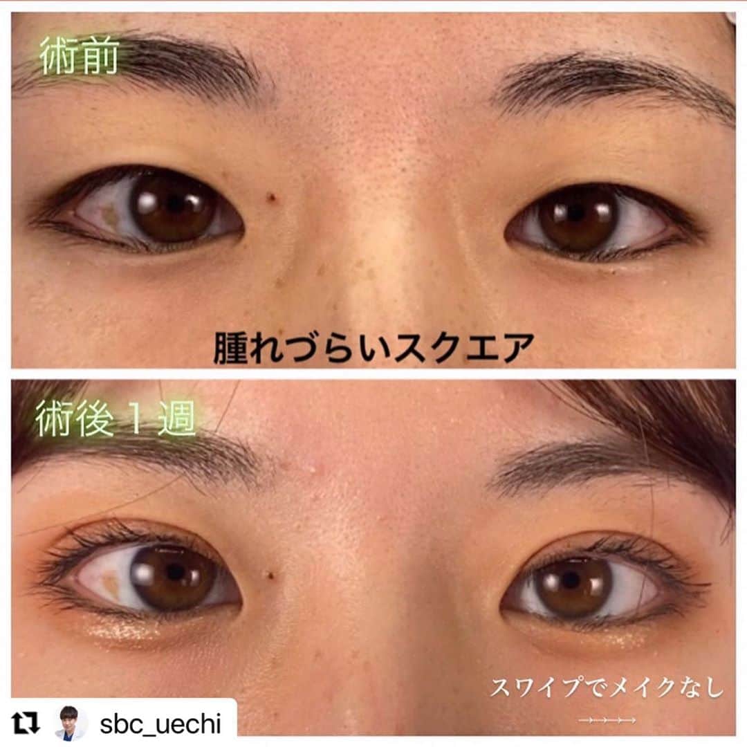 湘南美容外科 柏院さんのインスタグラム写真 - (湘南美容外科 柏院Instagram)「#Repost @sbc_uechi with @make_repost ・・・ 腫れづらいスクエア（埋没）を受けて頂いたモニターの方の術後経過です! 末広二重希望でした。 もともと一重ですが、目の開きは悪くない方でしたので、末広になる範囲内で二重幅は少し広めにしました！  二重手術をご検討の方は、是非湘南美容クリニックにご相談ください(^^)  気になる質問等ございましたら、DMで質問またはご来院ください🤗  電話でご予約の際は「上地のインスタを見た」とお伝えください！  🏥湘南美容クリニック柏院 📞0120-489-750  【腫れづらいスクエア　期間限定モニター料金】 ⭕️両目　49000円⭕️  ※腫れづらいスクエアは腫れづらいですが全く腫れないわけではありませんので、手術を受ける際はダウンタイムを考慮してお受けください。  ※瞼の皮膚のたるみ、蒙古襞、瞼の厚みの程度によっては また、手術には二重線の左右差、感染、内出血、術後の腫れ、埋没糸の露出、二重線の消失、予定外二重線等といった合併症・リスクがあります。その他の詳細については御来院された際に説明致します。  #美容 #美容整形 #湘南美容クリニック #湘南美容クリニック柏院 #二重 #末広二重　 #平行二重 #二重術 #埋没 #湘南二重術 #週末二重術 #腫れづらいスクエア二重術  #モニター #モニターモデル募集  #ダウンタイム #ヒアルロン酸 #ボトックス #可愛い #美人　 #美女 #綺麗  #アイメッド #オンライン診療 #オンライン相談 #若返り美容 #エイジングケア湘南 #たるみ改善湘南 #たるみ治療は湘南 #脱毛安い」9月10日 19時25分 - sbc_kashiwa