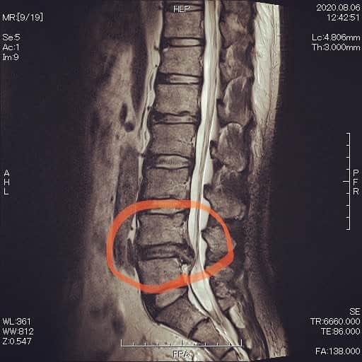 ケチャップ河合さんのインスタグラム写真 - (ケチャップ河合Instagram)「Twitterには書いたんですが。 明日手術します。 腰椎椎間板ヘルニアの手術です。 ゴリゴリに飛び出してるやつを切るらしいです。 復帰までしばらくお待ち下さい。  #腰椎椎間板ヘルニア  #手術  #腰痛持ちと繋がりたい  #立てないレベル  #カロリー制限食」9月10日 21時27分 - ketchupkawai
