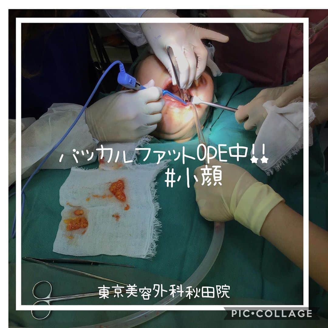 東京美容外科公式のインスタグラム：「東京美容外科秋田院です✨🧸♥️ . バッカルファットとは👩🏻‍⚕️ 頬の中央部の深い部分にある脂肪の塊です!🥩18歳頃までは高い位置にありますが加齢と共にだんだん下垂してくると、下ぶくれ顔やブルドック顔になり、たるみやほうれい線の原因ともなってしまいます😨 加齢によって下垂した脂肪を口の中から取り出し除去することで小顔効果やたるみの改善、予防をしてくれる治療です👨🏻‍⚕️!✨ また若いうちに除去しておくことで将来のたるみ予防にも効果的です🧏🏻‍♀️💓 . ☑️頬のたるみ、法令線が気になる ☑️ぽっちゃりした頬をなんとかしたい ☑️老化を予防したい ☑️小顔になりたい ☑️ブルドック顔になりたくない  そんか方に大人気です!🧏🏻‍♀️💓 施術時間は30分程度で腫れはほとんどありません。洗顔やシャワー、メイクは当日から可能です☝️☺️ . ==🎁お問い合わせはこちら🎁==== 詳しくはプロフィールのURLから公式サイトへ♪ ▼フリーダイヤル 0120-658-958 （コールセンター受付時間：9：00～21：00） ▼LINE予約 @ tkc110 ============== #東京美容外科 #東京美容外科秋田院 #美容整形 #きれい #整形 #美活 #綺麗になりたい #美肌 #美意識  #美容外科 #プチ整形 #アンチエイジング #美容好き#美容整形外科#秋田院の202008#顔のお肉#小顔になりたい#小顔#バッカルファット」
