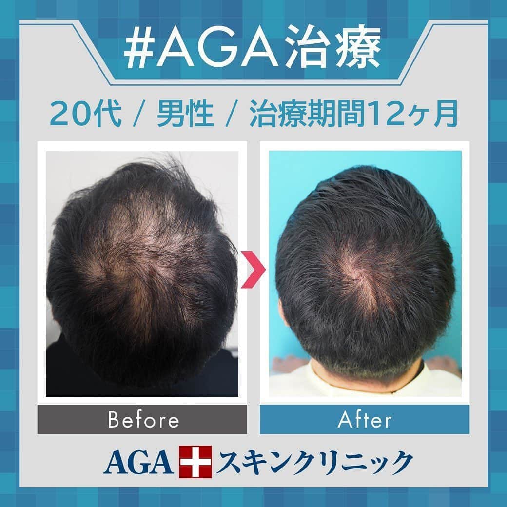 【公式】AGAスキンクリニックさんのインスタグラム写真 - (【公式】AGAスキンクリニックInstagram)「⭐️AGAスキンクリニック　Before⇒After⭐️ . 〇20代男性のケース 〇治療期間12か月 〇内容 ⇒オリジナル発毛薬 ⇒Dr'sメソ治療（AGA メソセラピー） . 頭頂の薄毛が目立たなくなってきました！ もう少しでつむじ回りまでしっかり埋まりそうです👏 . AGAは早期治療が肝心です。 クリニックなど詳細は、@aga_clinic より公式HPをチェックしてみてください🥰 . . #AGAスキンクリニック #AGA #男性型脱毛症 #AGA治療 #薄毛 #薄毛治療 #抜毛 #発毛 #育毛 #治療 #薬 #ミノキシジル #AGAスキンクリニック症例 #男性ホルモン #フィナステリド #デュタステリド #初期脱毛 #美容男子 #髪質改善 #頭皮ケア」8月19日 18時30分 - aga_clinic