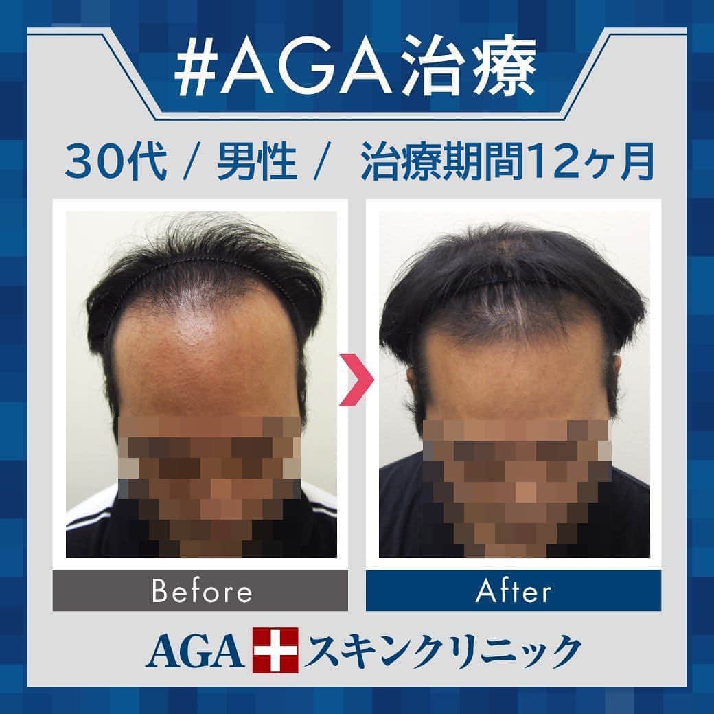 【公式】AGAスキンクリニックさんのインスタグラム写真 - (【公式】AGAスキンクリニックInstagram)「⭐️AGAスキンクリニック　Before⇒After⭐️ . 〇30代男性のケース 〇治療期間12か月 〇内容 ⇒オリジナル発毛薬 ⇒Dr'sメソ治療（AGA メソセラピー） . 後退していた生え際が改善されています！ 全体的な毛量もアップしましたね😊 . AGAは早期治療が肝心です。 クリニックなど詳細は、@aga_clinic より公式HPをチェックしてみてください🥰 . . #AGAスキンクリニック #AGA #男性型脱毛症 #AGA治療 #薄毛 #薄毛治療 #抜毛 #発毛 #育毛 #治療 #薬 #ミノキシジル #AGAスキンクリニック症例 #男性ホルモン #フィナステリド #デュタステリド #初期脱毛 #美容男子 #髪質改善 #頭皮ケア」8月19日 18時30分 - aga_clinic