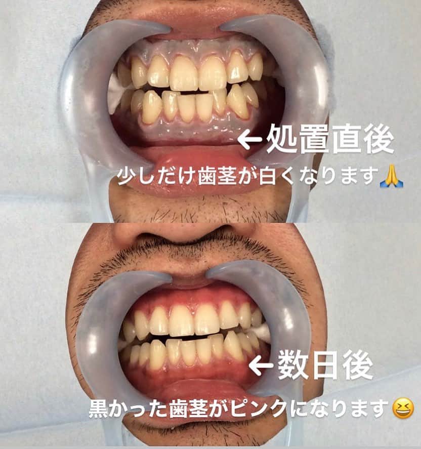 ホワイトニング専門クリニック ホワイトラボ東京 渋谷さんのインスタグラム写真 - (ホワイトニング専門クリニック ホワイトラボ東京 渋谷Instagram)「* #歯のホワイトニング @whitelabtokyo  * 今日は良くご質問をいただきます #歯茎のピーリング  についてお話したいと思います🙋‍♀️ * * 歯茎が少し茶色いな、もしくは結構黒いな という方は少なくないと思います。 歯茎の色は日に焼けやすい体質だったり、 タバコ🚬の影響によるものだったり様々な原因があります。 * * 歯茎はいくら気にしてもご自身でこの茶色〜黒の部分を取り除くことができません。 そこで！！ #ピーリング を用いてこれを治していきます👍🏻 * * ただし歯茎のピーリングはお顔のピーリングの薬剤は効きません🙅‍♀️ ご自身では危ないので行わない様にしてください。 * * 歯茎のピーリングは9800円です。 コースの組み合わせによっては4800円になります。 施術の時間はたった5分程度です🕰 * * 写真の様に、ピーリング施術当日〜2日間くらいはやや歯茎が白くなりますが、 今はマスクをしている時期なのでほとんど気にならないと思います😭 * * 2-3日で綺麗な歯茎に生まれ変わり、1週間ほどで落ち着いてきます。 ピーリングは基本的に1〜2年に1回くらいやっても大丈夫ですが、 歯茎が茶色くなる原因が無くなればもうやらなくても良くなります😃 * * 夏の終わり頃はたくさん　#紫外線 を浴びた後なので シミなどと同じで歯茎のケアをしても良いと思います！ 詳しくはスタッフにご相談ください。 #ホワイトニング はしないけどピーリングはしたいという方も大歓迎です🙋‍♀️✨ * #歯のケア #歯茎のケア #美容 #見た目も大事 #清潔感 #日焼け #スモーカー #口元のトータルビューティー #医療ホワイトニング #ホワイトニング渋谷 #ホワイトニング銀座 #ホワイトニング歯磨き粉 #ホワイトニング口コミ　#銀座美容  #メンズエステ #歯科衛生士 #歯科医師 #プロフェッショナル #カウンセリング無料 #1時間以内で終わります　#勧誘なしなので安心 #オーダーメイド #ブライダルホワイトニング #ブライダルホワイトニングならホワイトラボ東京 #プレ花嫁」8月19日 22時49分 - whitelabtokyo