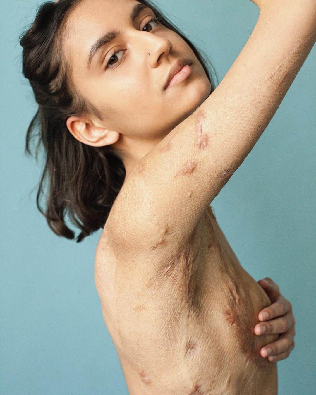 Vogue Australiaさんのインスタグラム写真 - (Vogue AustraliaInstagram)「Scars tell us so much about a person’s story. From cesareans and mastectomies to surgery after accidents, they are proof of strength and resilience. But scars are often stigmatised within our society, which puts a premium on blemish-free beauty. To read up on how we can improve the representation of scars, visit the link in our bio. 📷 Sophie Mayanne」8月20日 6時33分 - vogueaustralia