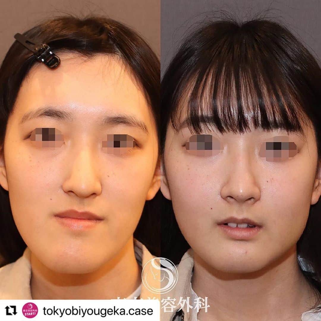 東京美容外科公式さんのインスタグラム写真 - (東京美容外科公式Instagram)「#Repost @tokyobiyougeka.case with @make_repost ・・・ 顎矯正手術を行った患者様の1ヶ月後の症例写真です。 ㅤㅤㅤㅤㅤㅤㅤㅤㅤㅤㅤ ➖➖➖➖➖➖➖➖➖➖➖➖ ✍🏻医師の解説 ➖➖➖➖➖➖➖➖➖➖➖➖ #REPOST @yamachan0706 シャクレ、長い顔、ガミー、非対称を一気に、いきなり治すSurgery First OGS﻿ ﻿ㅤㅤㅤㅤㅤㅤㅤㅤㅤㅤㅤ シャクレ、長い顔、ガミー、などはいずれもOGS（顎矯正手術：Le Fort1+SSRO；上下顎骨切り）によって治療が可能です... ㅤㅤㅤㅤㅤㅤㅤㅤㅤㅤㅤ 詳しい解説は 👇👇👇👇👇 山本 崇弘先生インスタアカウントへ @yamachan0706 ㅤㅤㅤㅤㅤㅤㅤㅤㅤㅤㅤ ➖➖➖➖➖➖➖➖➖➖➖➖ 💁‍♀️行った施術 ➖➖➖➖➖➖➖➖➖➖➖➖ 顎矯正手術（Le Fort1型骨切り＋SSRO＋オトガイ短縮前進）﻿智歯（親知らず）抜歯3本﻿ ㅤㅤㅤㅤㅤㅤㅤㅤㅤㅤㅤ ➖➖➖➖➖➖➖➖➖➖➖➖ 💡術後のリスクと注意点 ➖➖➖➖➖➖➖➖➖➖➖➖ 下口唇の痺れ﻿、プレート感染﻿、後戻り﻿、血腫、後出血﻿、鼻閉﻿、開口制限﻿、咬合不正など﻿ ㅤㅤㅤㅤㅤㅤㅤㅤㅤㅤㅤ ➖➖➖➖➖➖➖➖➖➖➖➖ 🗣お問い合わせ ➖➖➖➖➖➖➖➖➖➖➖➖ 🤳🏻フリーダイヤル 0120-658-958 電話受付時間：9：00～21：00 ❇️LINE予約 @ tkc110 ✉️メール プロフィールのURLから公式サイトへ 🔻🔻🔻🔻🔻🔻🔻🔻🔻🔻 📱無料WEBカウンセリング実施中！ 自宅からLINEのビデオ通話でドクターにご相談いただけます。WEBカウンセリング希望とお申し付けください🙇‍♀️ ➖➖➖➖➖➖➖➖➖➖➖➖ ㅤㅤㅤㅤㅤㅤㅤㅤㅤㅤㅤ #東京美容外科 #顔面非対称 #受け口 #形成外科 #美容外科 #輪郭手術 #輪郭 #形成外科専門医 #オトガイ形成 #矯正 #矯正治療 #3dシミュレーション #ガミースマイル #しゃくれ #下顎前突 #顎変形症 #美容 #美容マニア #美容好きな人と繋がりたい #サージェリーファースト #両顎手術 #イケメン #ホスト #美女 #キャバクラ #骨切り山ちゃん﻿」8月20日 18時55分 - tokyobiyougeka_jimukyoku