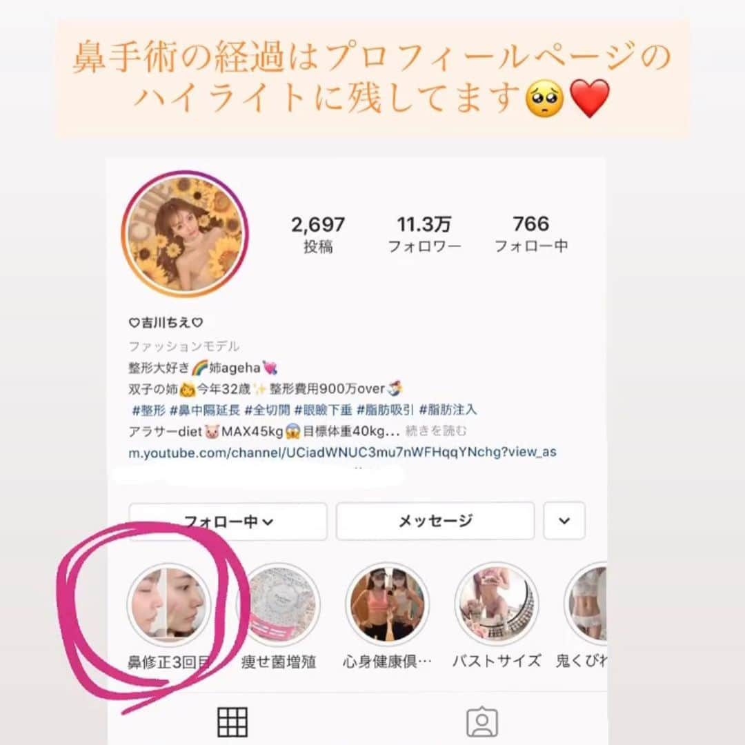 吉川ちえさんのインスタグラム写真 - (吉川ちえInstagram)「こんにちは🥺❣️ . 鼻の整形をして術後6日目です🧚💕 昨日ギプスが無事に取れて 自分の🆕新しい鼻とご対面しました👃❤️ . めちゃくちゃ鼻が理想通りのデザインに なってお気に入りです😭❣️❣️ 前回他院で下げ鼻にしてもらったけど自分の顔に似合わず🤣💣笑 . 今回は下げ鼻じゃなくてアップノーズで丸い印象の鼻にしてもらいました🧸🎀 正面から見ても鼻の穴が見えるようになって自然な感じになった気がする🤔💕 . 今回耳介軟骨👂を鼻先に入れたのですが耳の裏の傷もとっても綺麗🥺 鼻先はまだ赤くて固いです🙌 まだ腫れてるので100％完成ではないですが自分的にも気に入ってます🙋‍♀️💗💗 . プロテなどは入れてません✨ 自己組織でやってます🐻 ちなみに鼻の執刀医はリッツの 永井先生です🧑‍⚕️✨ ( @ritz_nagai ) ※昨日名前出し許可頂きました🙇‍♂️‼️ . とりあえず術後6日目はこんな感じです🦄💜 経過レポはプロフィールのハイライトに残してるから見てね🧚✨ . #整形 #鼻整形 #鼻修正 #長い鼻修正 #耳介軟骨移植 #整形好きと繋がりたい」8月20日 12時43分 - yoshikawachie_16