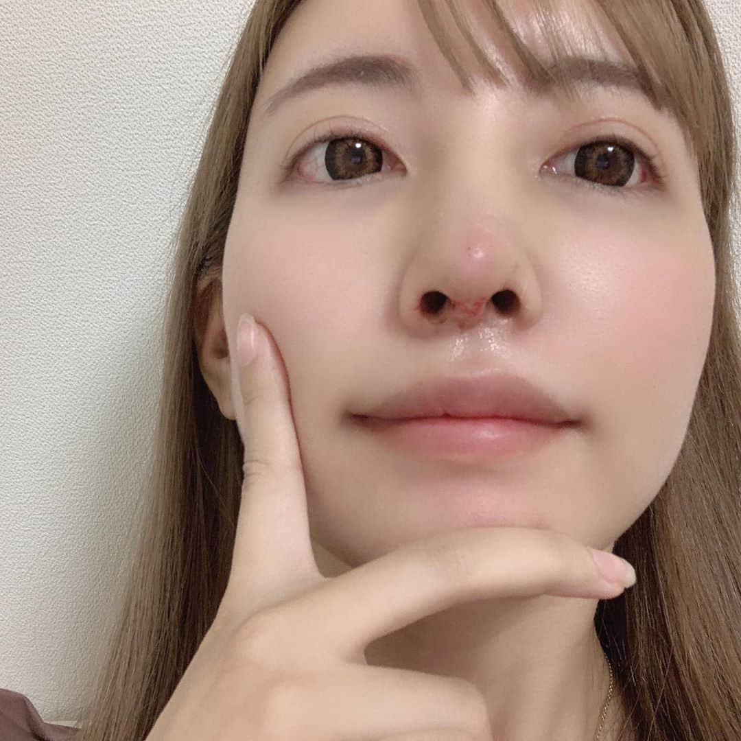 吉川ちえさんのインスタグラム写真 - (吉川ちえInstagram)「こんにちは🥺❣️ . 鼻の整形をして術後6日目です🧚💕 昨日ギプスが無事に取れて 自分の🆕新しい鼻とご対面しました👃❤️ . めちゃくちゃ鼻が理想通りのデザインに なってお気に入りです😭❣️❣️ 前回他院で下げ鼻にしてもらったけど自分の顔に似合わず🤣💣笑 . 今回は下げ鼻じゃなくてアップノーズで丸い印象の鼻にしてもらいました🧸🎀 正面から見ても鼻の穴が見えるようになって自然な感じになった気がする🤔💕 . 今回耳介軟骨👂を鼻先に入れたのですが耳の裏の傷もとっても綺麗🥺 鼻先はまだ赤くて固いです🙌 まだ腫れてるので100％完成ではないですが自分的にも気に入ってます🙋‍♀️💗💗 . プロテなどは入れてません✨ 自己組織でやってます🐻 ちなみに鼻の執刀医はリッツの 永井先生です🧑‍⚕️✨ ( @ritz_nagai ) ※昨日名前出し許可頂きました🙇‍♂️‼️ . とりあえず術後6日目はこんな感じです🦄💜 経過レポはプロフィールのハイライトに残してるから見てね🧚✨ . #整形 #鼻整形 #鼻修正 #長い鼻修正 #耳介軟骨移植 #整形好きと繋がりたい」8月20日 12時43分 - yoshikawachie_16