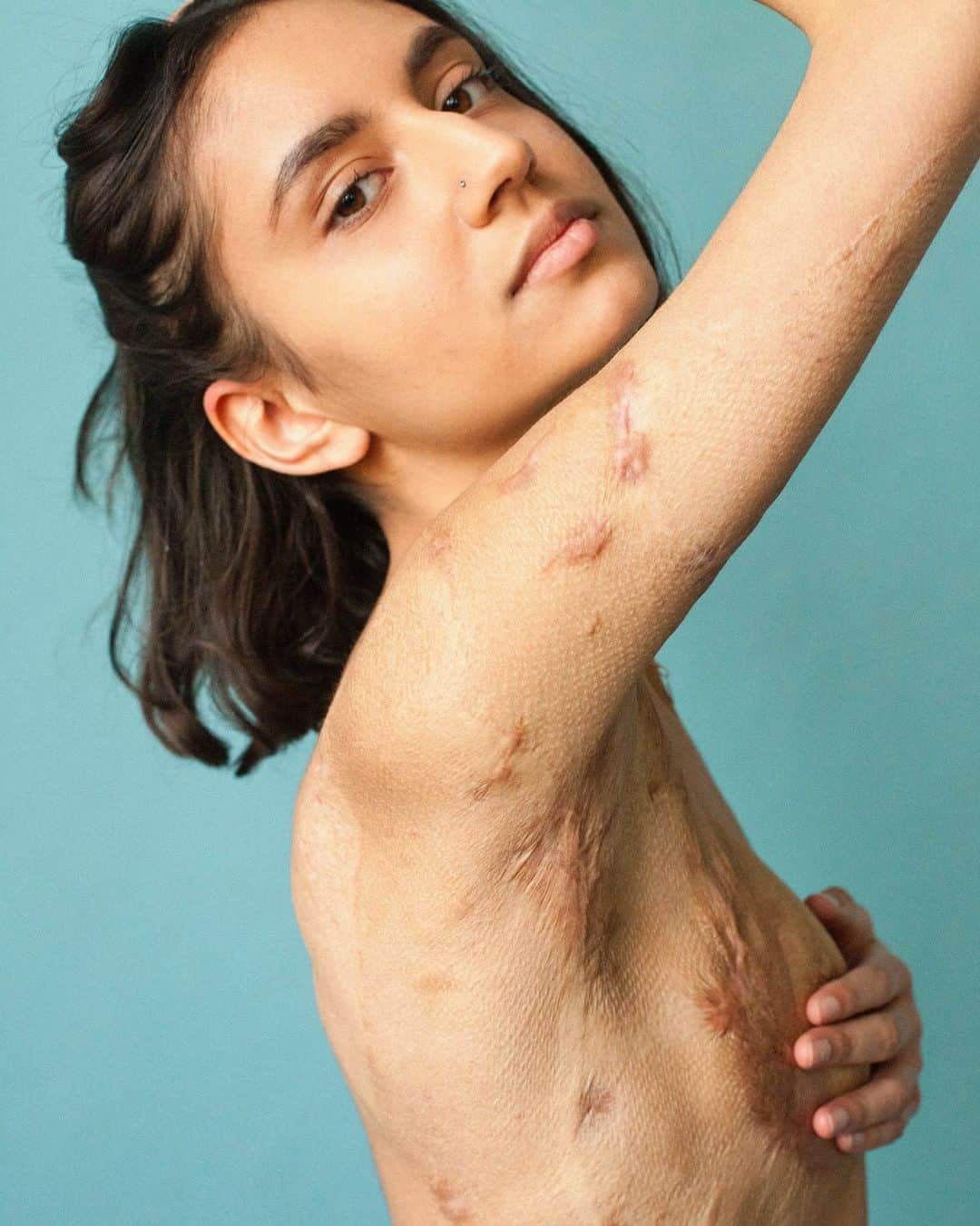 British Vogueさんのインスタグラム写真 - (British VogueInstagram)「In the era of filters, dispelling the stigma of scarred skin is more important than ever. Scars tell us so much about a person’s story and whether incurred as a result of caesarean sections and mastectomies or surgery after accidents, they are proof of strength and resilience. At the link in bio, #BritishVogue speaks to the people campaigning to improve the representation of scars, from @SophieMayanne’s powerful photography project, @BehindTheScars_, to Philadelphia-based @CrownAndFeatherTattoo, whose mission is to cover scars with beautiful works of art.」8月20日 17時25分 - britishvogue