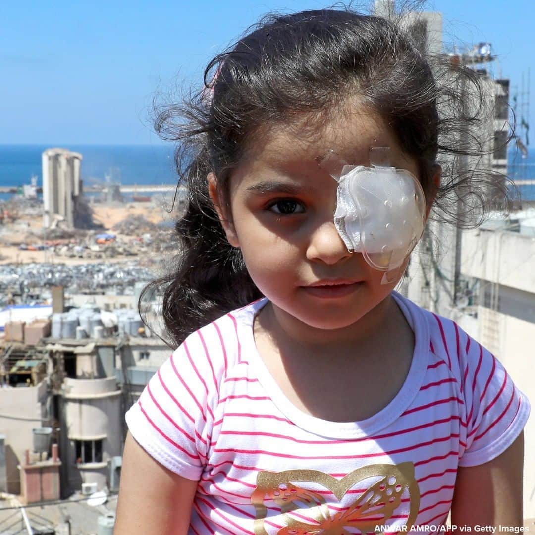 ABC Newsさんのインスタグラム写真 - (ABC NewsInstagram)「Six-year-old Syrian girl who lost her left eye in the devastating Beirut explosion poses for a picture on the roof of her damaged house in the Lebanese capital's Mar Mikhael district overlooking the blast site. #beirut #lebanon」8月20日 21時33分 - abcnews