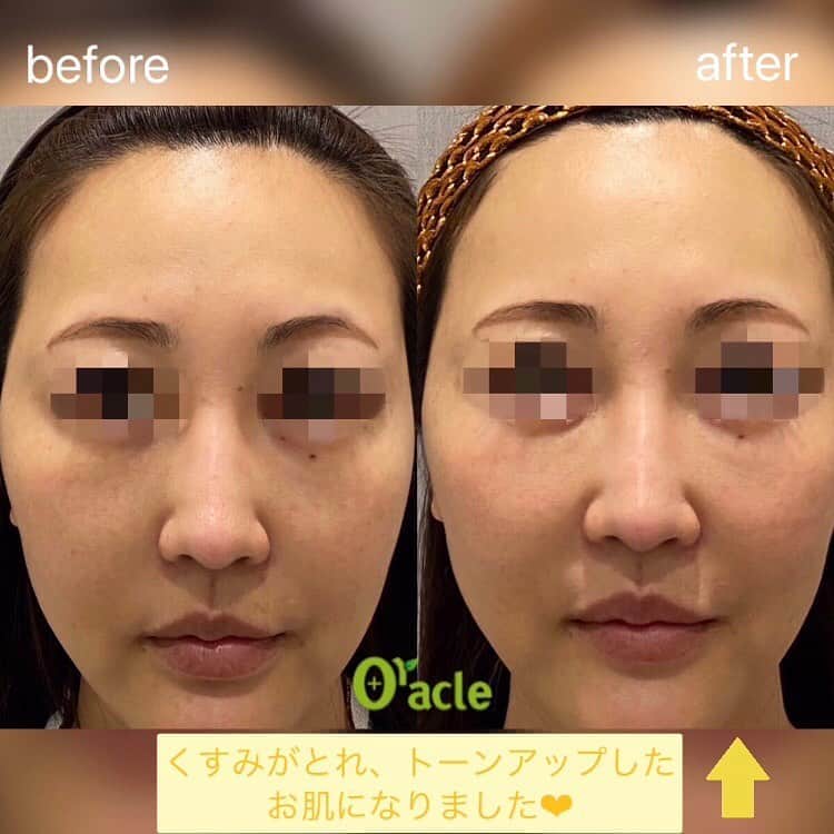 オラクル美容皮膚科東京新宿院さんのインスタグラム写真 - (オラクル美容皮膚科東京新宿院Instagram)「﻿ マイルドレーザーでお肌の毛穴改善、キメ・ハリ感UP➚﻿ ﻿ 📌毛穴の開き﻿ 📌小じわ﻿ 📌赤ら顔﻿ 📌ニキビ跡の赤み﻿ 📌キメ﻿ ﻿ マイルドなレーザーで肌のターンオーバーを整えることでまるでたまごのようなつるつるお肌に👼﻿ ﻿ ダウンタイムもなく、継続していくことで﻿ トータル的な美肌を叶えます💎﻿ ﻿ ﻿ ﻿ ジェネシスレーザー[新宿限定]﻿ 💴1回10,000円(税抜)﻿ ﻿ ⚠️リスクなど﻿ まれに赤みや熱感が出ることがありますが1～2時間ほどで落ち着いていきます。﻿ ﻿ ▪️▫️▪️▫️▪️▫️▪️▫️▪️▫️﻿ ﻿ 🇯🇵オラクル美容皮膚科🇰🇷﻿ 📍東京新宿院﻿ 新宿3丁目19-4 MLJ新宿8階﻿ ﻿ 📍名古屋院﻿ 名古屋市中区錦3丁目24-4﻿ サンシャイン栄5階﻿ ﻿ 【専門】﻿ ニキビ（跡）／毛穴／シミ／しわ／たるみ／痩身／アンチエイジング／美白美肌治療全般／ブライダル相談／メンズ美容﻿ ﻿ 🗝完全予約制﻿ 👠土日祝日も診療﻿ ﻿ 【予約方法】﻿ ☎0120-905-696﻿ ⏰9:00～21:00［年中無休］﻿ ﻿ LINE、メール24時間📧﻿ LINE🆔 @oracle.jp ﻿ 📩HPメールフォームよりお願いいたします﻿ ﻿ ﻿ ▪️▫️▪️▫️▪️▫️▪️▫️▪️▫️﻿ ﻿ #オラクル美容皮膚科 #オラクル ﻿ #oracle #韓国美容 #美容皮膚科 ﻿ #皮膚科 #美容 #小顔矯正 #コラーゲン #美容オタク #美容マニア  #ヒアルロン酸 #弾力 #ハリ #美白 #保湿 #ゆらぎ肌 #일본피부과 #오라클피부과 #リフトアップ #シワ #美肌 #美肌ケア #肌管理 #韓国美容皮膚科 #アンチエイジング #ジェネシスレーザー #たまご肌 #毛穴 #赤ら顔」8月21日 14時37分 - oraclejp