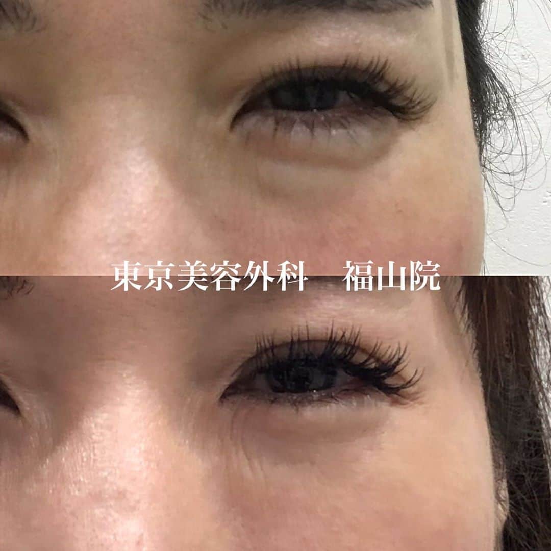 東京美容外科公式のインスタグラム：「東京美容外科　福山院です😊 毎日暑い日が続きますが、皆さまいかがお過ごしでしょうか？  本日は裏ハムラ法の症例です🌻 加齢により、目の下の眼窩脂肪が飛び出る事で膨らみの影が疲れた印象に。 これが黒グマの原因です。  脂肪を凹んでいる所に移動をし、不要な脂肪を取り出す事によりスッキリとしたお目元に✨  ⚠️リスク 内出血、腫れ、へこみ  💰料金 ¥550,000  【東京美容外科】 ====□お問い合わせはこちら□===== ▼フリーダイヤル ☎0120-658-958 （コールセンター受付時間：9：00～21：00） . ▼LINE予約 @ tkc110 ============== #東京美容外科#福山#オルチャンリフト#ニキビ肌#汗管腫#綺麗#beautiful#二重#プチ#kawaii#コンプレックス #アイプチ#卒業#キャンペーン#モデル#モニター#目力#美容#美意識#女子力#可愛い #美容クリニック」