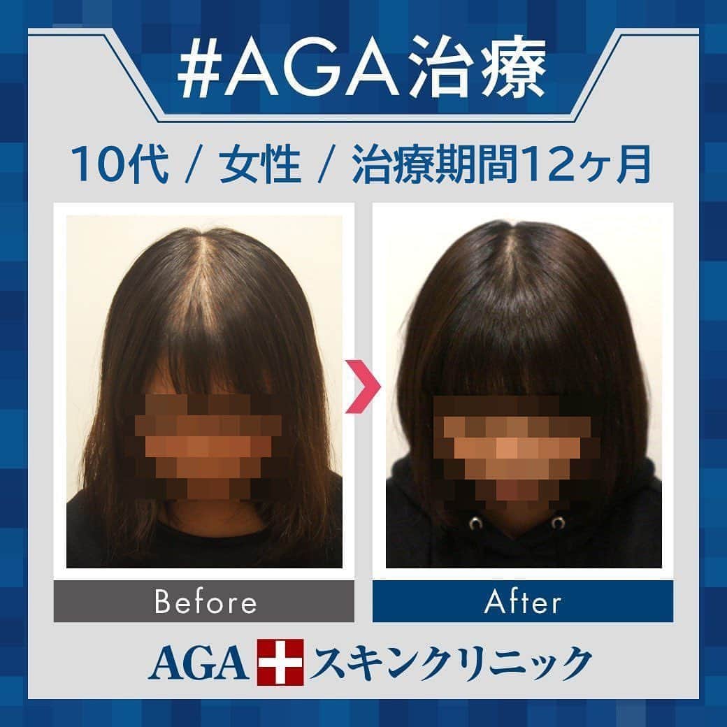 【公式】AGAスキンクリニックさんのインスタグラム写真 - (【公式】AGAスキンクリニックInstagram)「⭐️AGAスキンクリニック　Before⇒After⭐️ . 〇10代女性のケース 〇治療期間12か月 〇内容 ⇒オリジナル発毛薬 ⇒Dr'sメソ治療（AGA メソセラピー） . 女性に多い分け目の薄毛に悩まれていた方です。 前髪の薄さがきになってしまうほど進行されていましたが 治療後は分け目も前髪も全く気にらなくなりましたね💗 . AGAは早期治療が肝心です。 クリニックなど詳細は、@aga_clinic より公式HPをチェックしてみてください🥰 . . #AGAスキンクリニック #AGA #FAGA #男性型脱毛症 #女性型脱毛症 #AGA治療 #薄毛 #薄毛治療 #抜毛 #発毛 #育毛 #治療 #薬 #ミノキシジル #AGAスキンクリニック症例 #初期脱毛 #髪質改善 #頭皮ケア」8月24日 10時13分 - aga_clinic