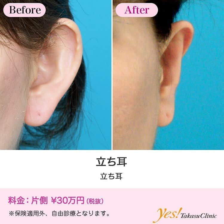 高須クリニックのインスタグラム：「👨🏻‍⚕️高須幹弥医師からのコメント✨⠀ 30代の女性です。いつも耳を隠すような髪型をしていましたが、それでも耳が飛び出してきたり、髪の流れが上手く決まらないなどの悩みを抱えていました。ご本人は耳が大きいと思い込んでいたのですが、実は角度が前に向いている立ち耳。正面から見たときに耳が開いていると、耳ばかりが目立って顔全体のバランスも悪く見えがちです。寝かせるように角度を修正するだけで、耳が目立たなく。もう髪で隠す必要もなくなり、思いっきり好きなヘアースタイルが楽しめますね。 ---------------------------------------------------- 🌈料金✨⠀ ●立ち耳 片側 ¥300,000【東京、横浜、名古屋、大阪】 ---------------------------------------------------- ⚠️リスク・副作用・合併症✨⠀ ●立ち耳 軟膏ガーゼによる枕固定・水濡れ注意（術後） 仕上がりのわずかな左右差（完璧なシンメトリーは不可） --------------------------------------------------- 😊施術についての詳細✨⠀⠀ https://www.takasu.co.jp/photo/tachimimi02.html ---------------------------------------------------- 📞ご予約・お問い合わせ✨⠀ 0120-5587-10⠀ https://www.takasu.co.jp/cgi-bin/form/contact.cgi ※症例写真や施術に関するご質問なども上記までお願い致します。 ---------------------------------------------------- #立ち耳 #耳の角度を変える手術 #目立つ耳をなんとかしたい #耳への視線が気になる #耳と顔のバランスを整えたい #耳を修正したい  #皮膚 #美容 #美肌 #エイジングケア #美容整形 #美容外科 #美容クリニック #美容好き #美容皮膚科 #モニター #モニター募集 #高須クリニック #高須クリニック名古屋 #高須幹弥 #整形したい #プチ整形 #症例 #症例写真 #可愛くなりたい #可愛い #美人」
