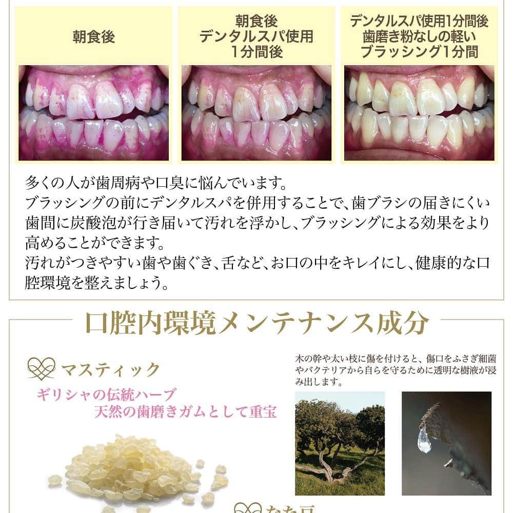 吉松育美さんのインスタグラム写真 - (吉松育美Instagram)「. Dental spa✨It's a carbonated foam oral care. 😁😛😁😛Made in Japan. 🇯🇵🦷🦷🦷 . . #デンタルスパ で毎日お口ケア❤️❤️❤️私は毎朝派です✨😚そして最後は炭酸うがいまでして喉もスッキリ💕🤗✨ . ファンの間ではなぜかデンタルフグという可愛いあだ名まで🦷🦷🦷✨炭酸パワーでお口の中で炭酸がはじけてフグのようになるんだよね🥰笑 . . 今はコロナでうがいも必須だからデンタルスパはめちゃめちゃ重宝してます🥳 . . . .  .  . #dentalspa_tansan_magic #dentalcare #oralcare #carbonated #tansan #tansanmagic #デンタルスパ #お口ケア #炭酸うがい #口臭ケア #口腔ケア #歯垢 #炭酸美容」8月27日 11時45分 - ikumiyoshimatsu