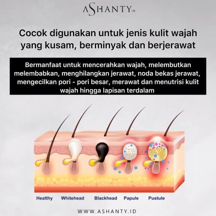 ASHANTY BEAUTY CREAM OFFICIALのインスタグラム：「Tidak pede karena jerawat terus menghantui, wajah kusam dan berminyak ? Tenannnnng Ladies, atasi dengan Acne Cream Series by Ashanty 💙  Bantu atasi masalah kulit wajah kusam, berminyak dan berjerawat. Bermanfaat untuk mencerahkan wajah, melembutkan, melembabkan, membantu menghilangkan jerawat, noda bekas jerawat dan mengecilkan pori - pori besar.  ______________________________ Informasi dan pemesanan  Ashanty Beauty Cream  WA: 081287388885 WA: 081293823950 WA: 087778489900 WaA: 085781140354 ⚡️ Fast Respons Click Link On Bio Instagram @ashantyid ❣️ ______________________________ #ashantybeautycream #creamashanty #skincareashanty #skincare #skincareartis #skincarelokal #creamwajah #creamperawatanwajah #obatjerawat #jerawat #kosmetik #krimwajah #creamwajah #whiteningcream #ashantyid #ashanty #ahha #kepastian #aurelhermansyah」