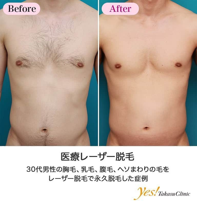高須クリニックのインスタグラム：「👨🏻‍⚕️高須幹弥医師からのコメント✨⠀ 30代男性で、胸毛、乳毛（乳輪周りの毛）、腹毛、ヘソ毛（ヘソ周りの毛）の脱毛を希望していたので、レーザー脱毛で永久脱毛することになりました。 約2ヶ月間隔で計7回照射したところ、ほぼ完全に毛がなくなり、すべすべつるつるの肌になりました。 胸毛やヘソ周りの毛がなくなることにより、大胸筋（胸板の筋肉）や腹直筋（腹筋）が浮き出ているのがはっきりと見えるようになり、逞しい体に見えるようになりました。 男性で胸毛やヘソ周りの毛が生えていても、あまり得をすることはなく、むしろ損をすることのほうが多いです。 「すべすべの綺麗な肌の男性が好き」という女性は多いですが、「胸毛やヘソ毛が生えている毛深い男性が好き」という女性は今の世の中あまりいません。 特に最近の若い女の子は「毛深い男性は嫌い」「胸毛が生えている毛深い男性は不潔そうに見える」「すべすべの肌の男性が好き」という意見が多いです。 ---------------------------------------------------- 🌈料金✨⠀ ●医療レーザー脱毛　胸 初回~5回目までの1回毎 ¥40,000 / 1年間フリープラン ¥200,000【全院】 ※「1年間フリープラン」は上限8回までの施術とさせていただきます。 ●医療レーザー脱毛　乳輪周囲 1回毎 ¥15,000【全院】 ※「1年間フリープラン」は上限8回までの施術とさせていただきます。 ●医療レーザー脱毛　おなか（へそ周り含む） 初回~5回目までの1回毎 ¥40,000 / 1年間フリープラン ¥200,000【全院】 ※「1年間フリープラン」は上限8回までの施術とさせていただきます。 ---------------------------------------------------- ⚠️リスク・副作用・合併症✨⠀ ●医療レーザー脱毛 肌のほてり・発赤（照射後／肌が弱い方・敏感肌の方） 日焼けした肌に脱毛レーザーを照射すると火傷のリスク 照射後間もない時期に日焼けをすると、シミや色素沈着 一時的な毛嚢炎 --------------------------------------------------- 😊施術についての詳細✨⠀⠀ https://www.takasu.co.jp/photo/epi09.html ---------------------------------------------------- 📞ご予約・お問い合わせ✨⠀ 0120-5587-10⠀ https://www.takasu.co.jp/cgi-bin/form/contact.cgi ※症例写真や施術に関するご質問なども上記までお願い致します。 ---------------------------------------------------- #医療レーザー脱毛 #レーザー脱毛 #永久脱毛 #胸毛脱毛 #ヘソ毛脱毛  #皮膚 #美容 #美肌 #エイジングケア #美容整形 #美容外科 #美容クリニック #美容好き #美容皮膚科 #モニター #モニター募集 #高須クリニック #高須クリニック名古屋 #高須幹弥 #整形したい #プチ整形 #症例 #症例写真 #可愛くなりたい #可愛い #美人」