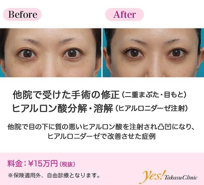 高須クリニックのインスタグラム：「👨🏻‍⚕️高須幹弥医師からのコメント✨⠀ 30代の女性で、もともと目の下が窪んでクマが目立っていたため、他院で目の下の窪みにヒアルロン酸を注射されました。 しかし、安価なヒアルロン酸だったのと、丁寧に注射されなかったためか、左側は必要以上に膨らんで、不自然になっていました。 目の下の皮膚は非常に薄いので、目の下専用の軟らかいヒアルロン酸を丁寧に注射しないと、このようになってしまいます。 左側だけヒアルロニダーゼを注射して、一旦元に戻すことになりました。 当院のヒアルロニダーゼは、質の良いものを高濃度にして、極細の注射針で注射するため、これくらいの量のヒアルロン酸ならば、12時間程度で、ほとんど腫れることなく分解・吸収されてしまいます。 注射後はヒアルロン酸は完全になくなり、また窪んでしまいましたが、不自然さはなくなりました。 ヒアルロン酸と同様ヒアルロニダーゼもピンからキリまであり、安価な質の悪いヒアルロニダーゼは効果が少なく、注射後に強い腫れがでますが、質の良いヒアルロニダーゼは、1回の注射で大部分のヒアルロン酸を分解吸収させることができ、腫れもほとんどありません。 ---------------------------------------------------- 🌈料金✨⠀ ●ヒアルロン酸分解・溶解（ヒアルロニダーゼ注射） ¥150,000【全院】 ---------------------------------------------------- ⚠️リスク・副作用・合併症✨⠀ ●ヒアルロン酸分解・溶解（ヒアルロニダーゼ注射） 内出血（注射針が血管に当たってしまった場合） アレルギーが生じる可能性 --------------------------------------------------- 😊施術についての詳細✨⠀⠀ https://www.takasu.co.jp/photo/hyaluronjyokyo05.html ---------------------------------------------------- 📞ご予約・お問い合わせ✨⠀ 0120-5587-10⠀ https://www.takasu.co.jp/cgi-bin/form/contact.cgi ※症例写真や施術に関するご質問なども上記までお願い致します。 ---------------------------------------------------- #他院で受けた手術の修正 #ヒアルロン酸分解 #ヒアルロン酸溶解 #ヒアルロニダーゼ注射  #皮膚 #美容 #美肌 #エイジングケア #美容整形 #美容外科 #美容クリニック #美容好き #美容皮膚科 #モニター #モニター募集 #高須クリニック #高須クリニック名古屋 #高須幹弥 #整形したい #プチ整形 #症例 #症例写真 #可愛くなりたい #可愛い #美人」